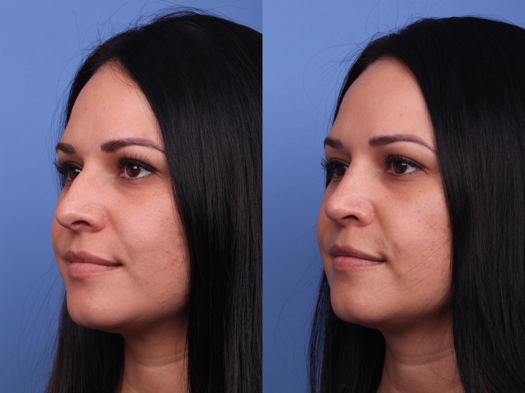 Before & After Rhinoplasty Case 286 View #3 View in Scottsdale, AZ