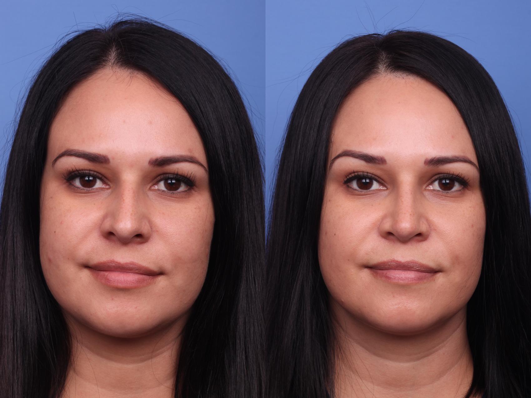Before & After Rhinoplasty Case 286 View #4 View in Scottsdale, AZ