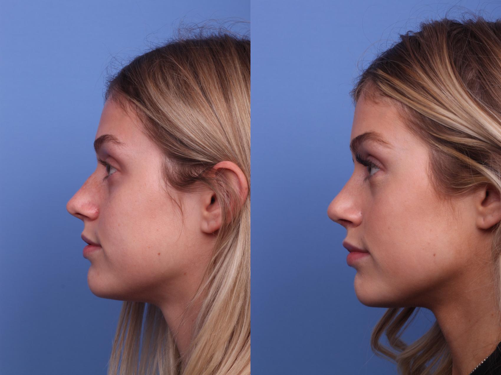 Before & After Rhinoplasty Case 287 View #2 View in Scottsdale, AZ