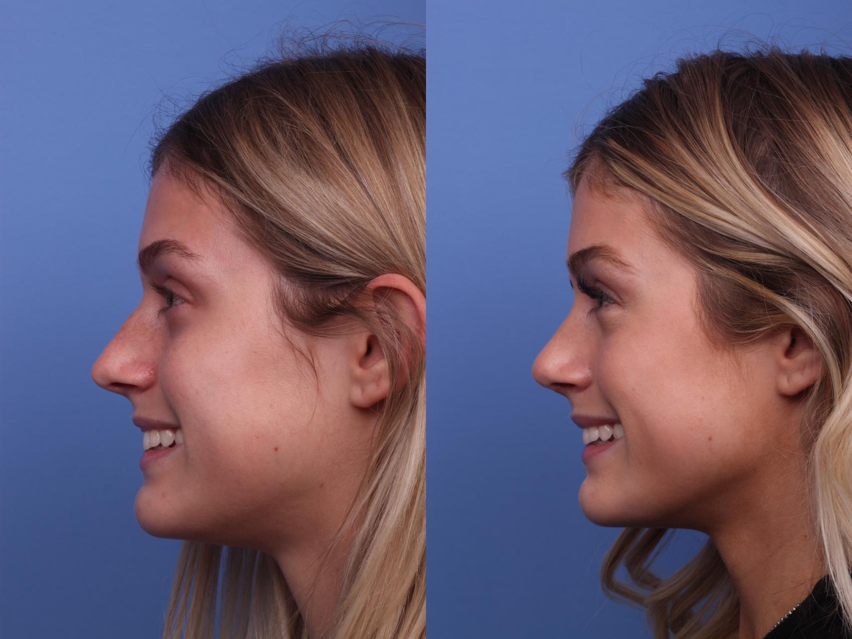 Before & After Rhinoplasty Case 287 View #3 View in Scottsdale, AZ