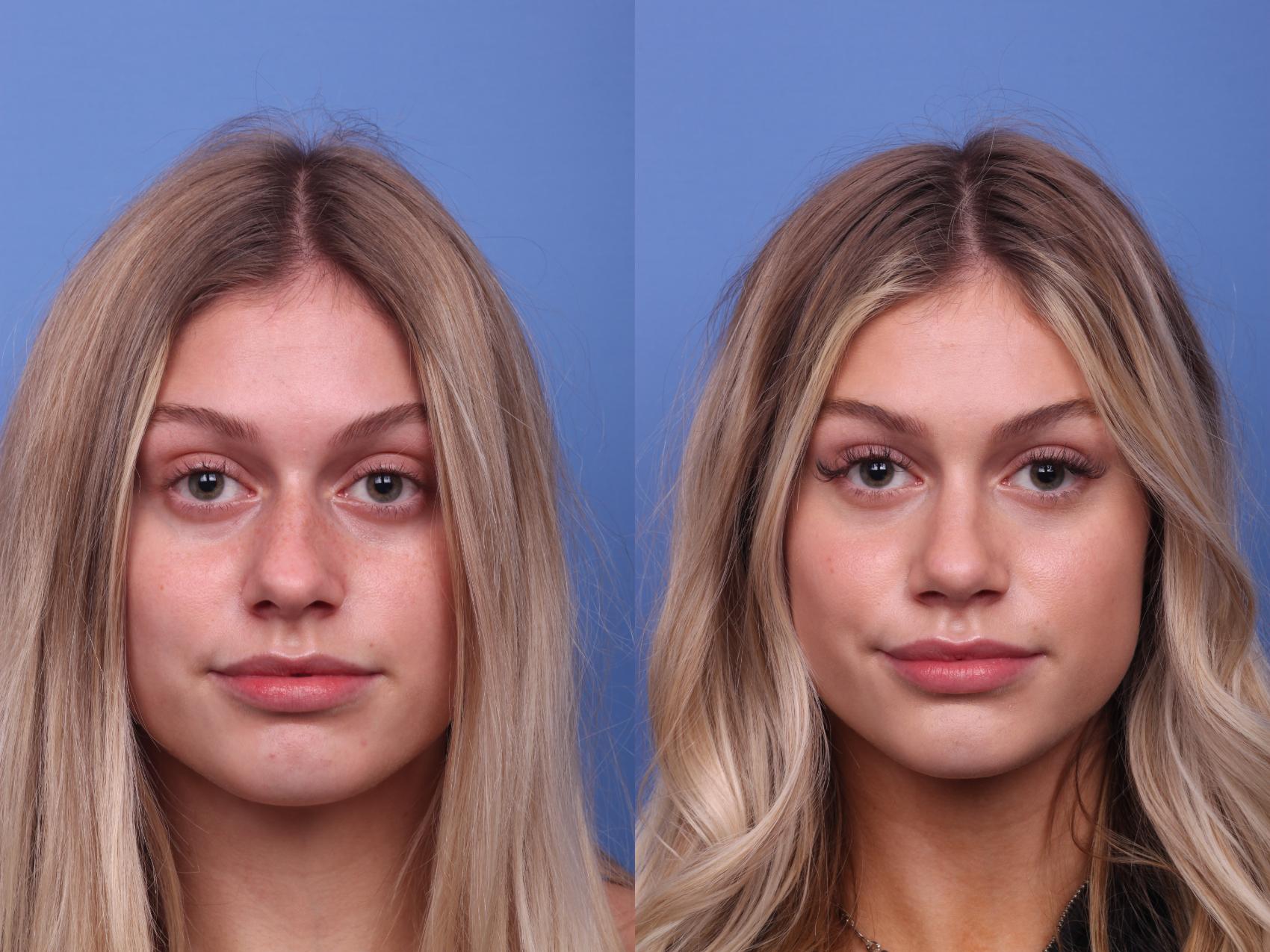 Before & After Rhinoplasty Case 287 View #4 View in Scottsdale, AZ