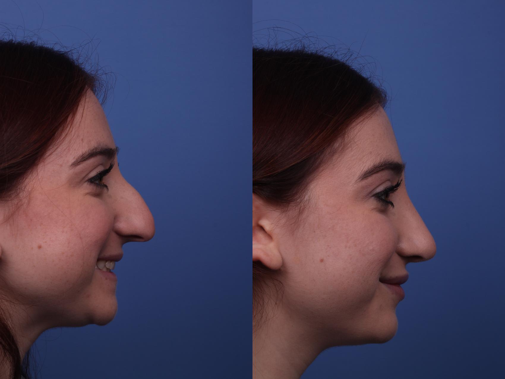 Before & After Rhinoplasty Case 288 View #2 View in Scottsdale, AZ