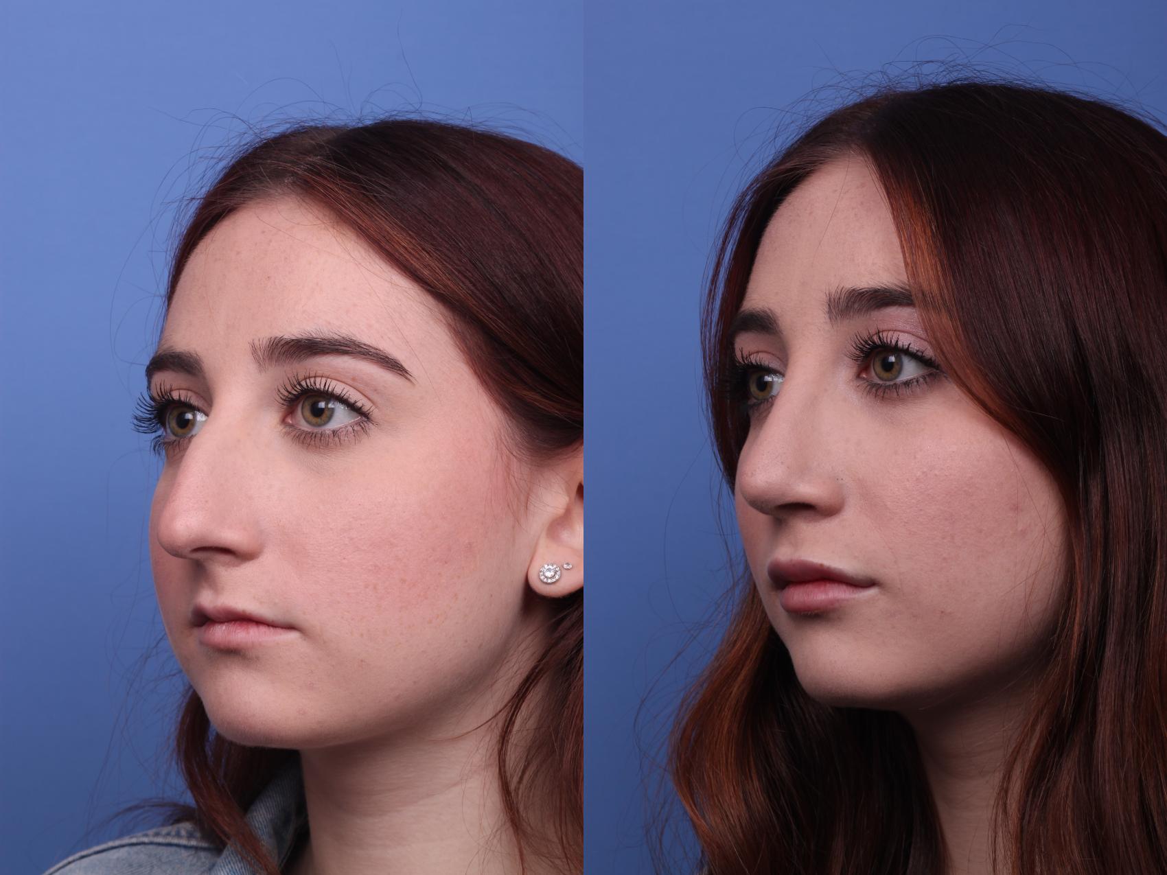 Before & After Rhinoplasty Case 288 View #3 View in Scottsdale, AZ