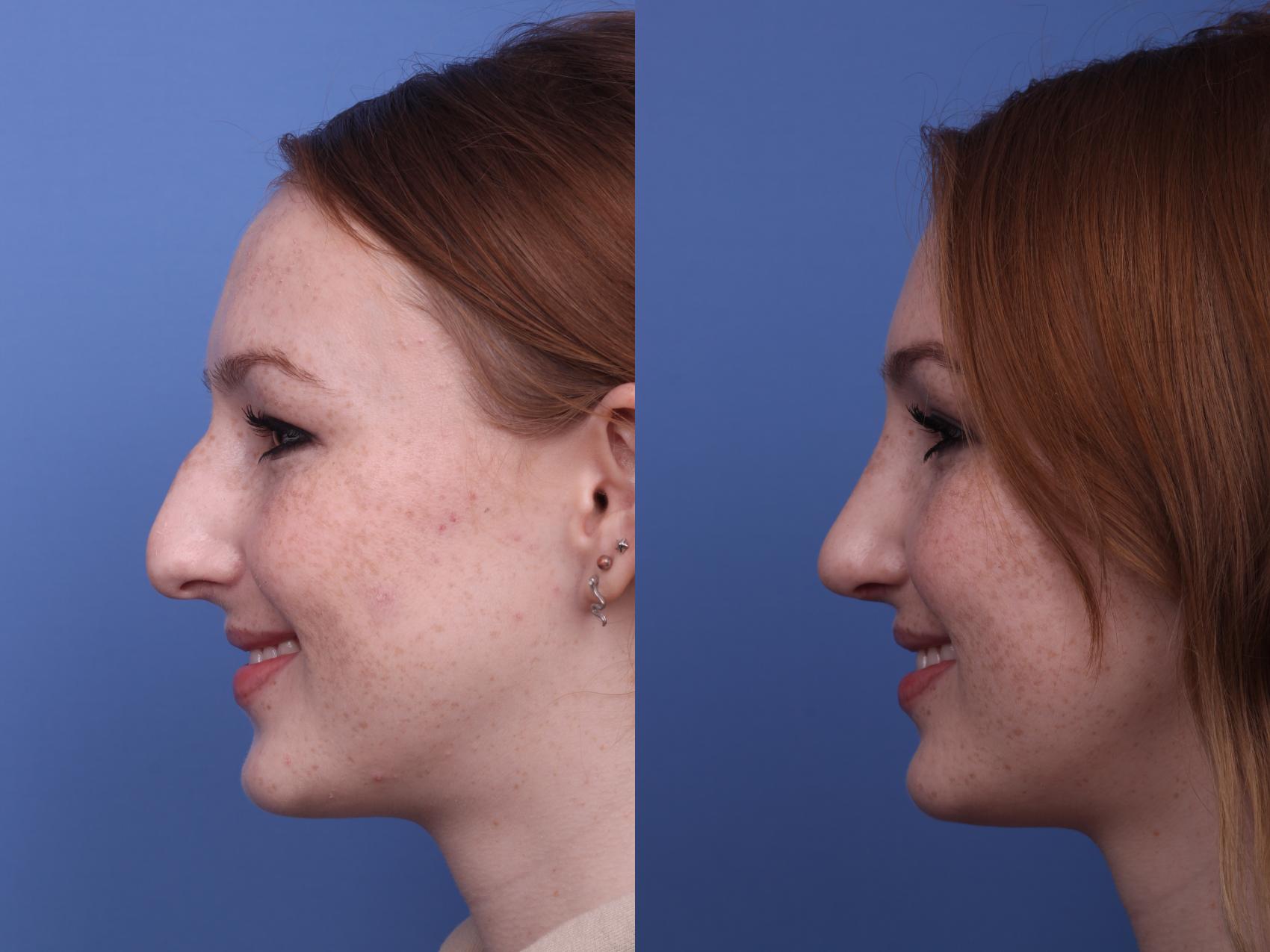 Before & After Rhinoplasty Case 289 View #2 View in Scottsdale, AZ