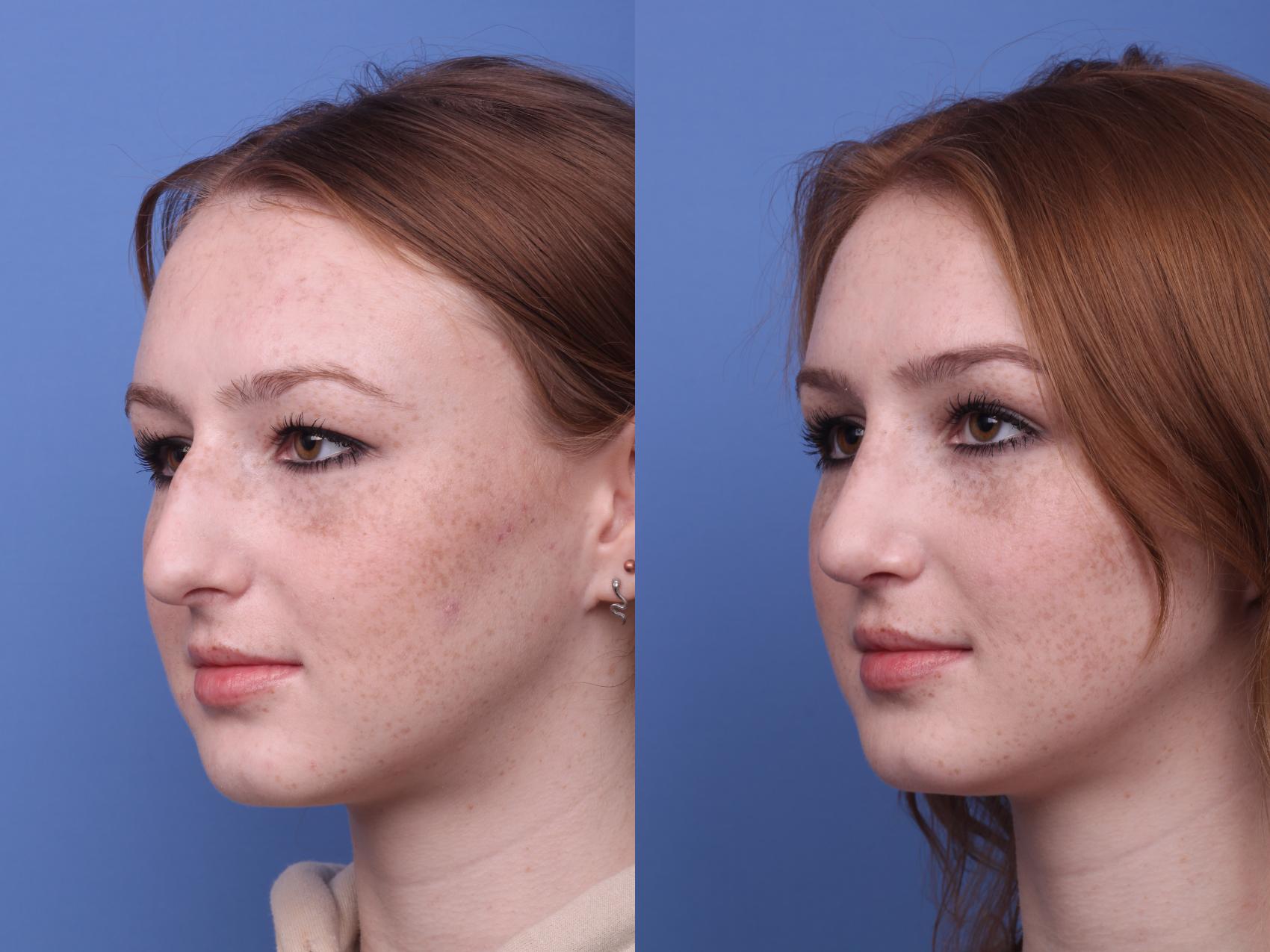 Before & After Rhinoplasty Case 289 View #3 View in Scottsdale, AZ