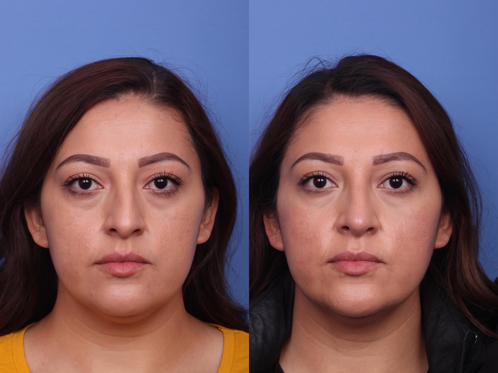 Before & After Rhinoplasty Case 290 View #1 View in Scottsdale, AZ