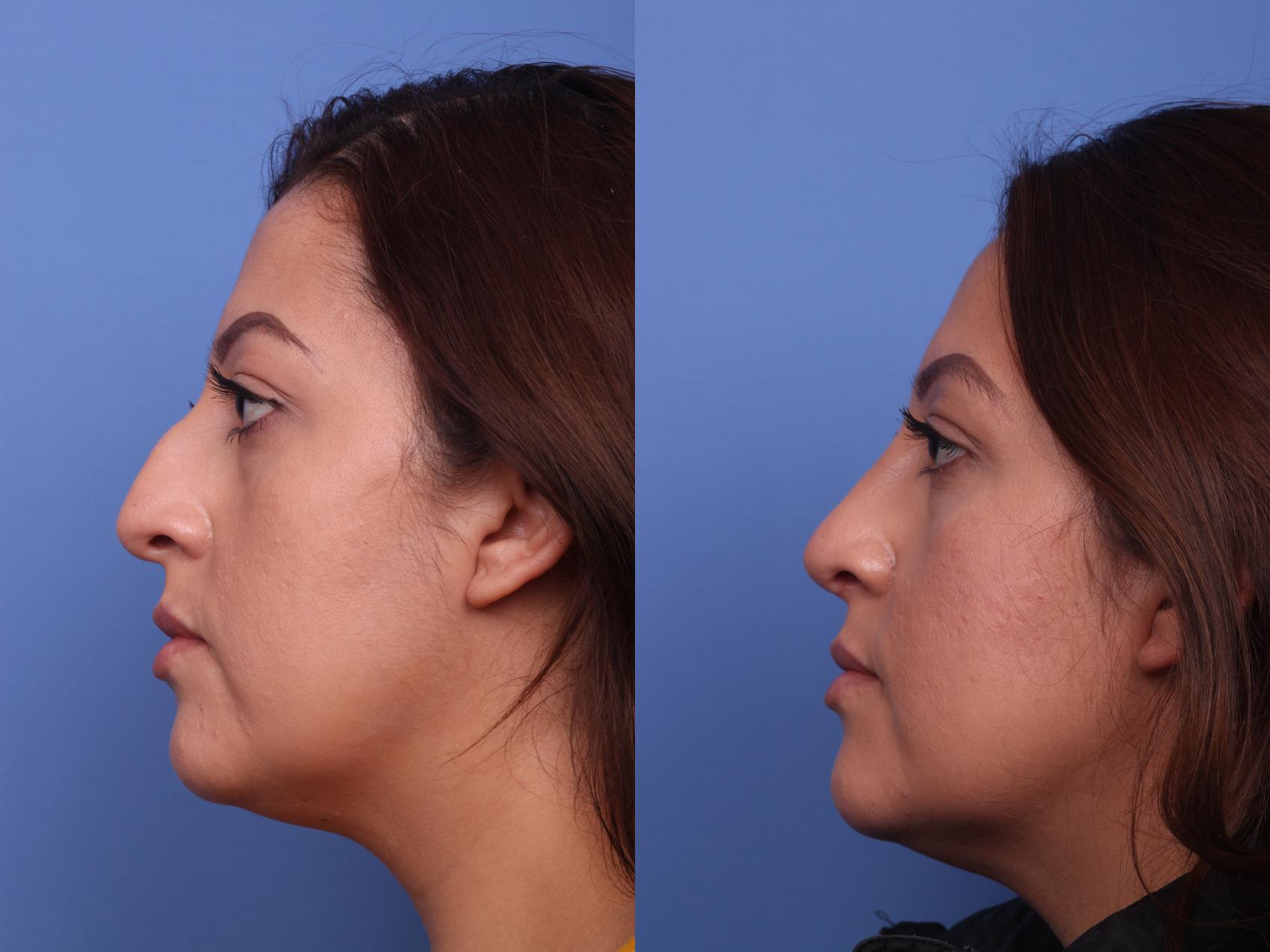 Before & After Rhinoplasty Case 290 View #2 View in Scottsdale, AZ