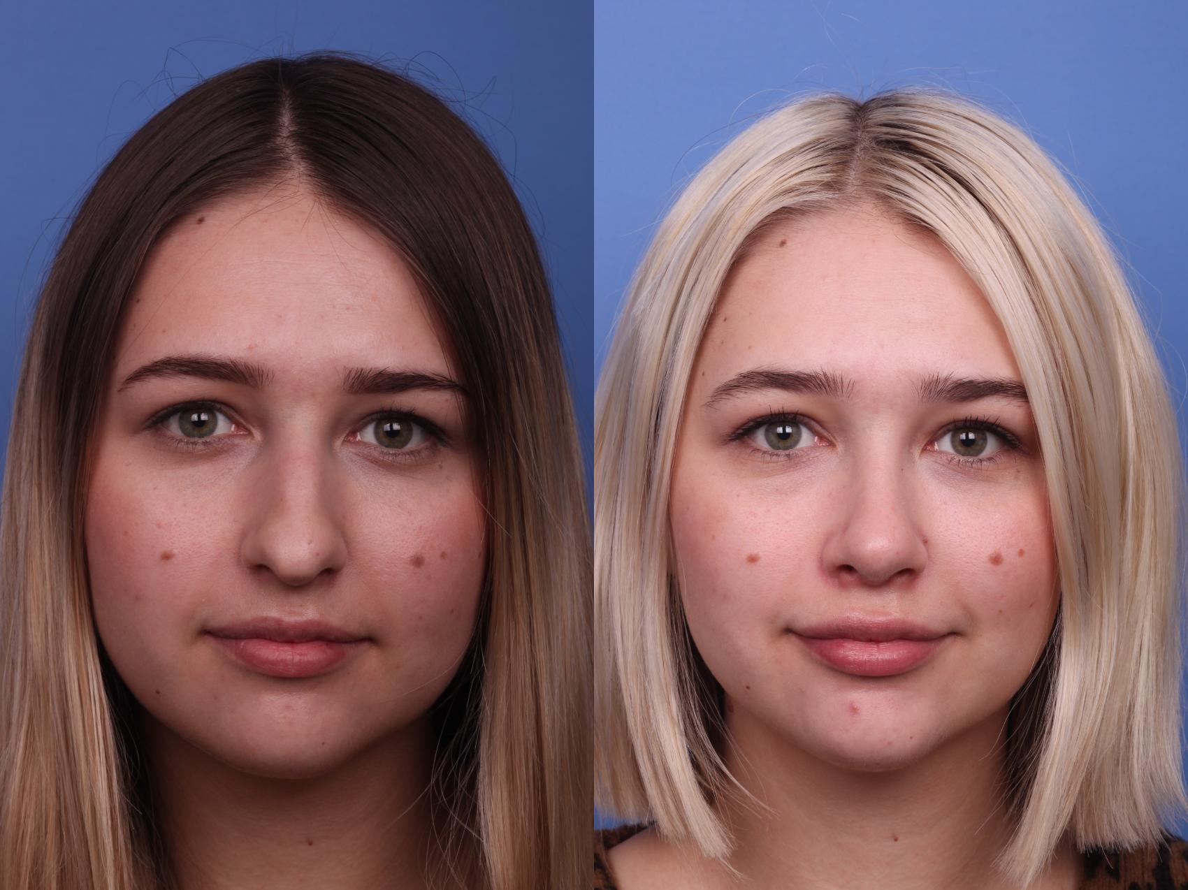 Rhinoplasty Before & After Photo | Scottsdale, AZ | Hobgood Facial Plastic Surgery: Todd Hobgood, MD