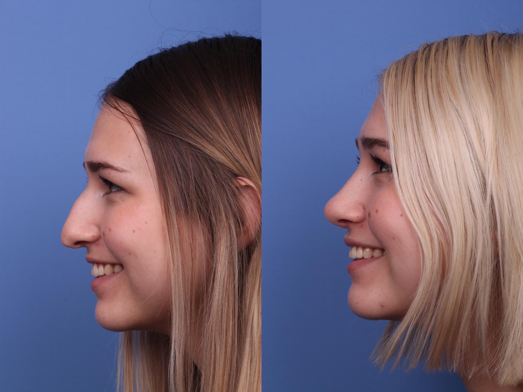 What A Nose Job Would Look Like At Daniel Mcbryde Blog What A Nose Job Would Look Like At Daniel Mcbryde Blog
