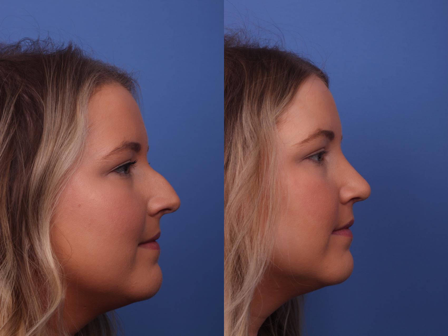 Before & After Rhinoplasty Case 292 View #2 View in Scottsdale, AZ