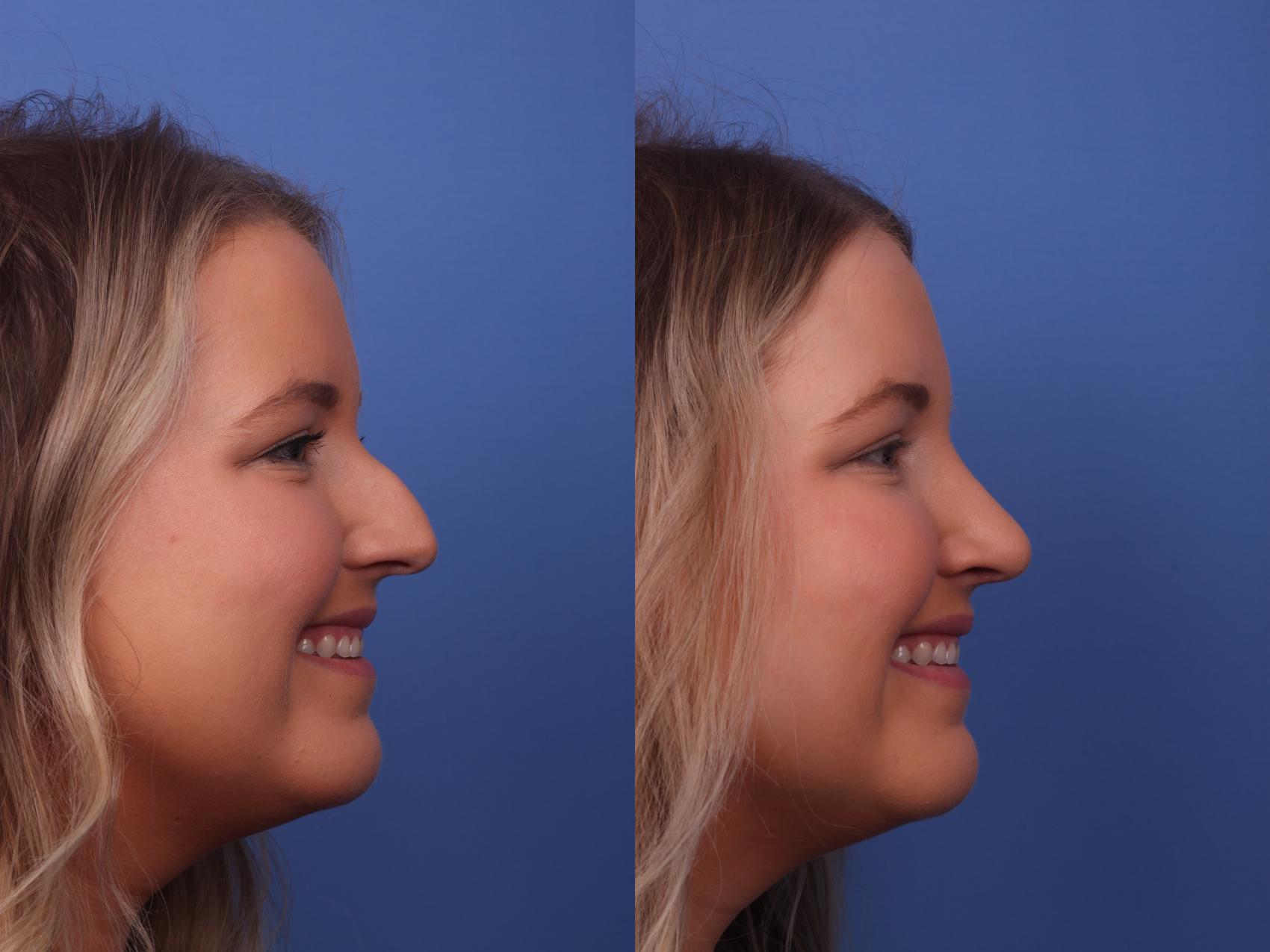 Before & After Rhinoplasty Case 292 View #3 View in Scottsdale, AZ