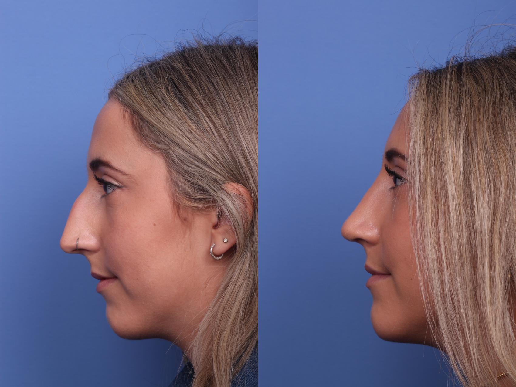 Before & After Rhinoplasty Case 293 View #2 View in Scottsdale, AZ