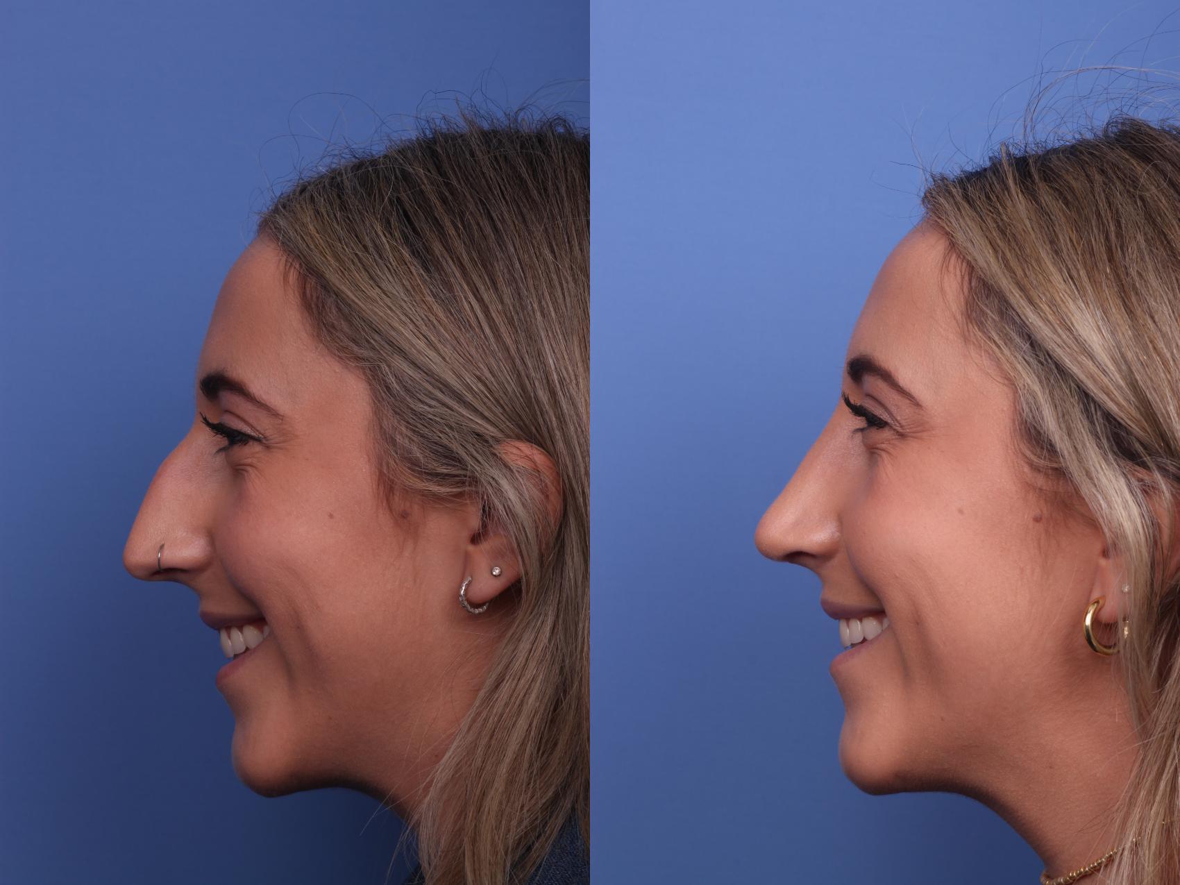 Before & After Rhinoplasty Case 293 View #3 View in Scottsdale, AZ