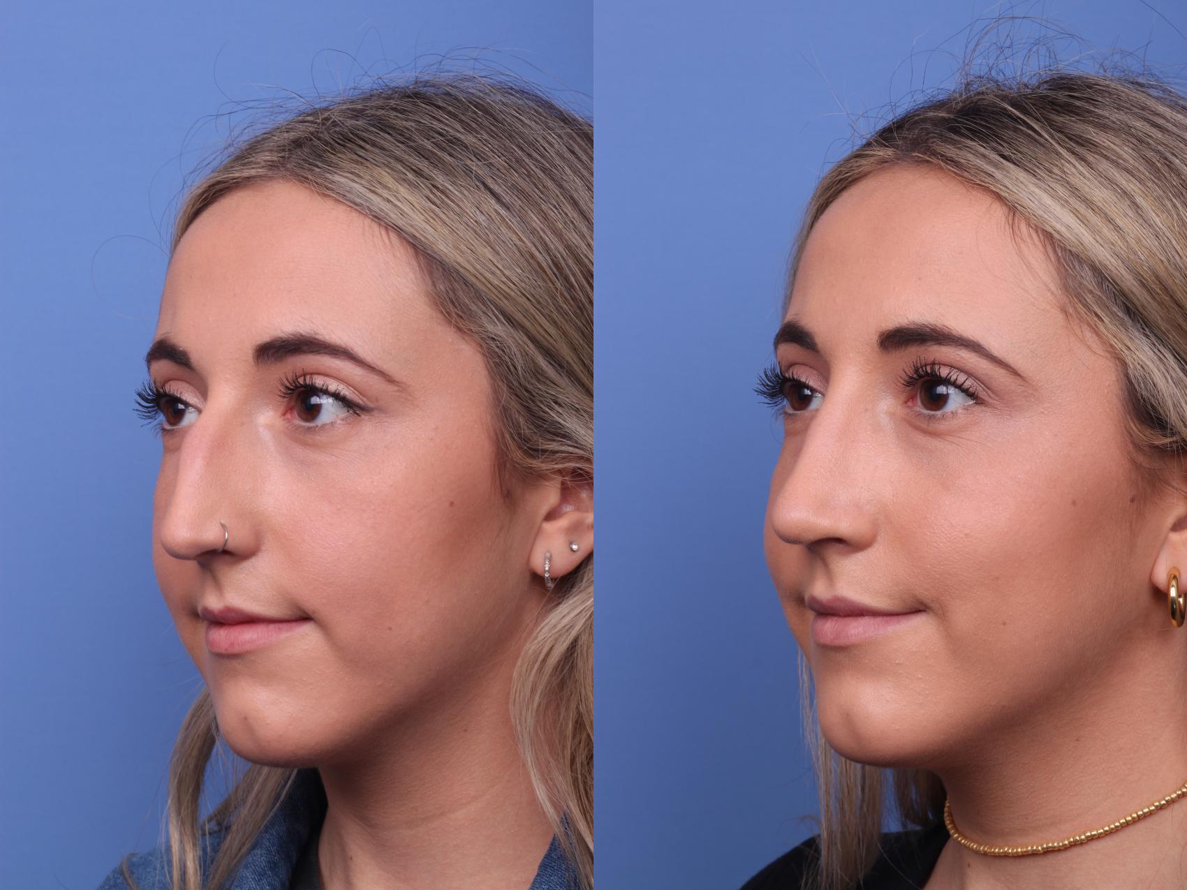 Before & After Rhinoplasty Case 293 View #4 View in Scottsdale, AZ