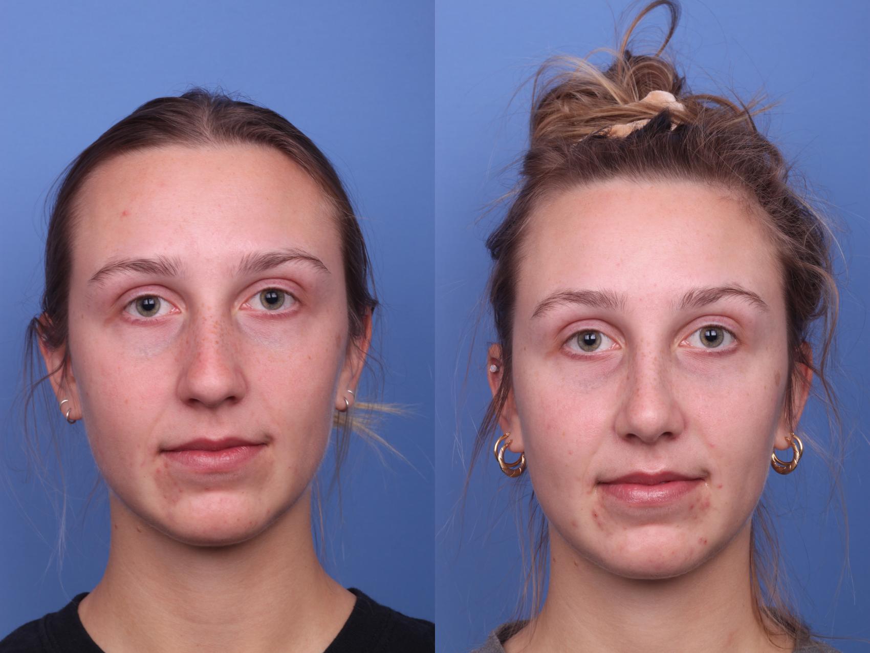 Before & After Rhinoplasty Case 294 View #2 View in Scottsdale, AZ