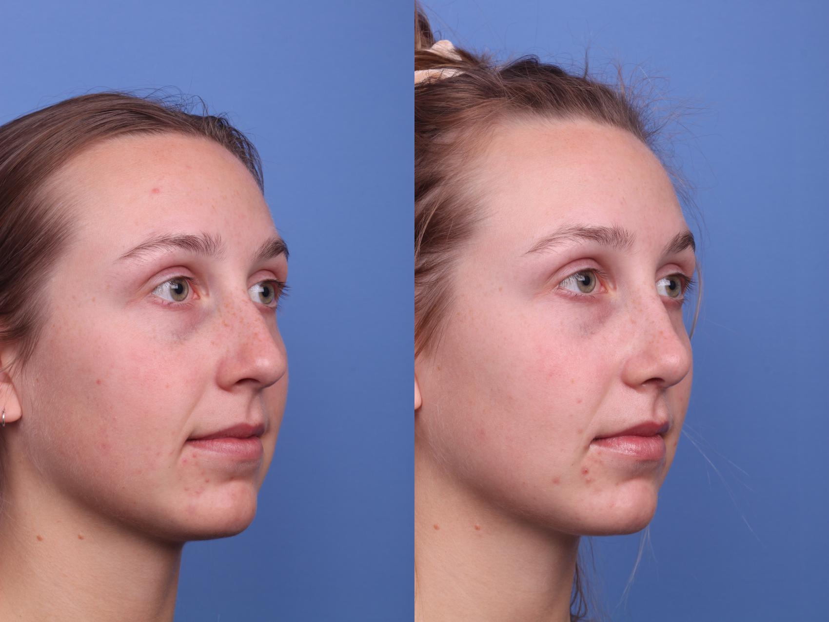 Before & After Rhinoplasty Case 294 View #3 View in Scottsdale, AZ