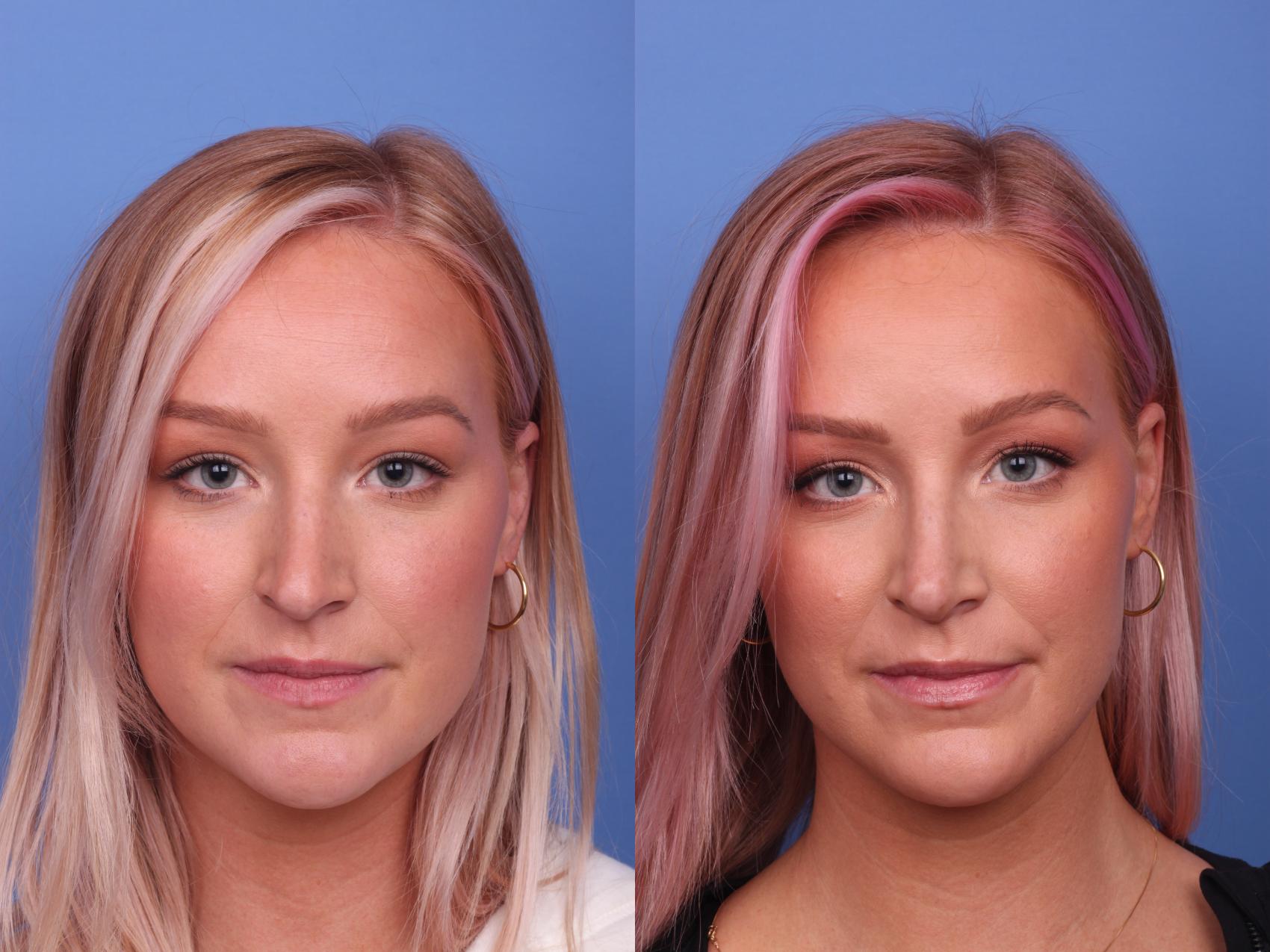 Before & After Rhinoplasty Case 298 View #2 View in Scottsdale, AZ