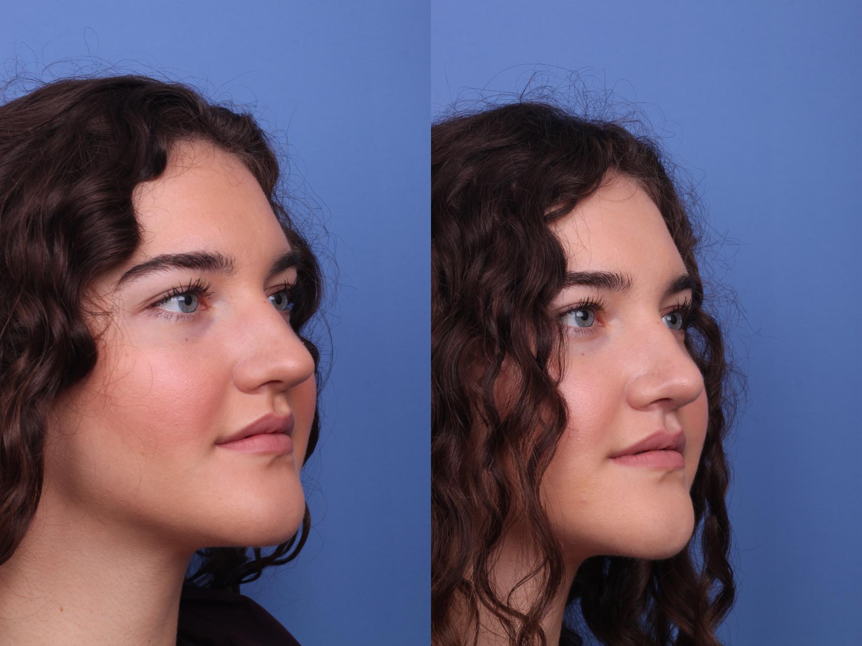 Before & After Rhinoplasty Case 300 View #2 View in Scottsdale, AZ