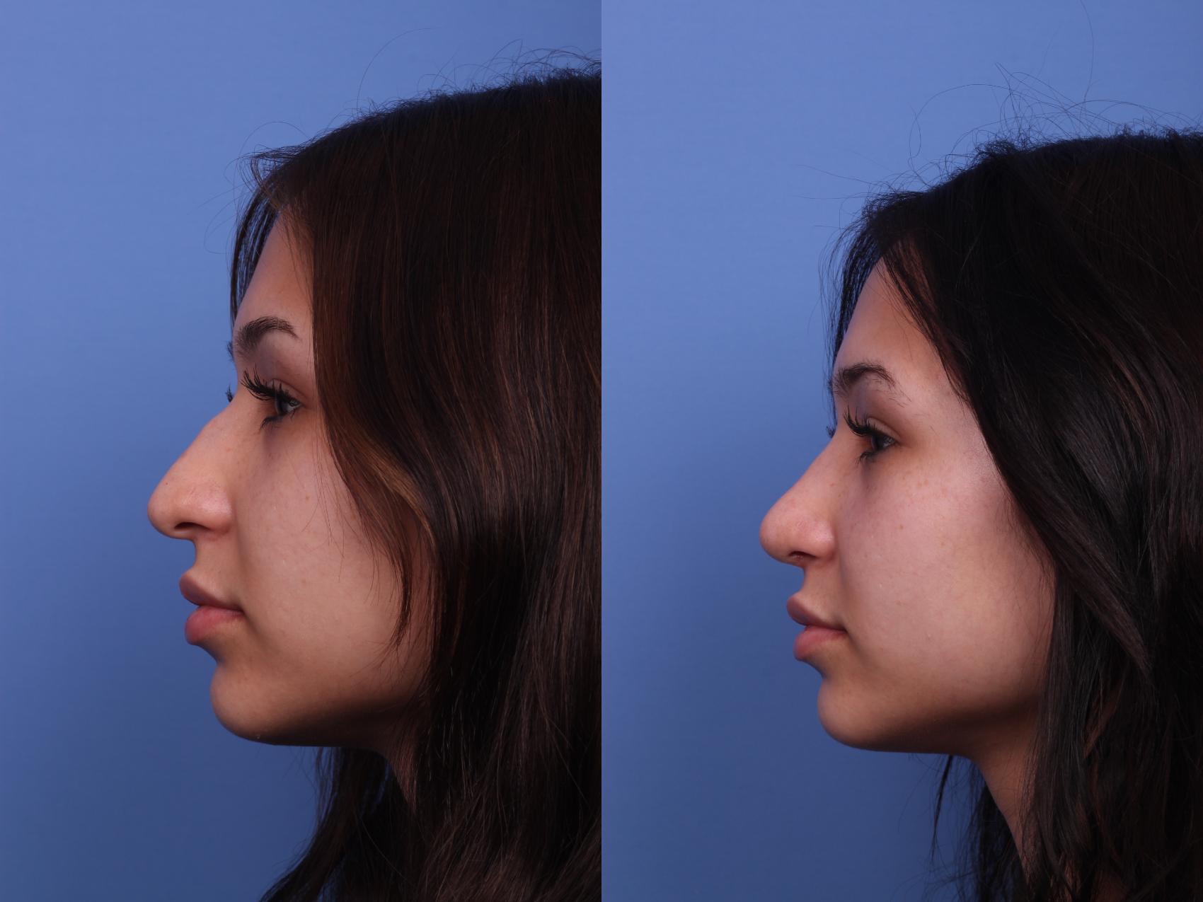 Before & After Rhinoplasty Case 301 View #2 View in Scottsdale, AZ