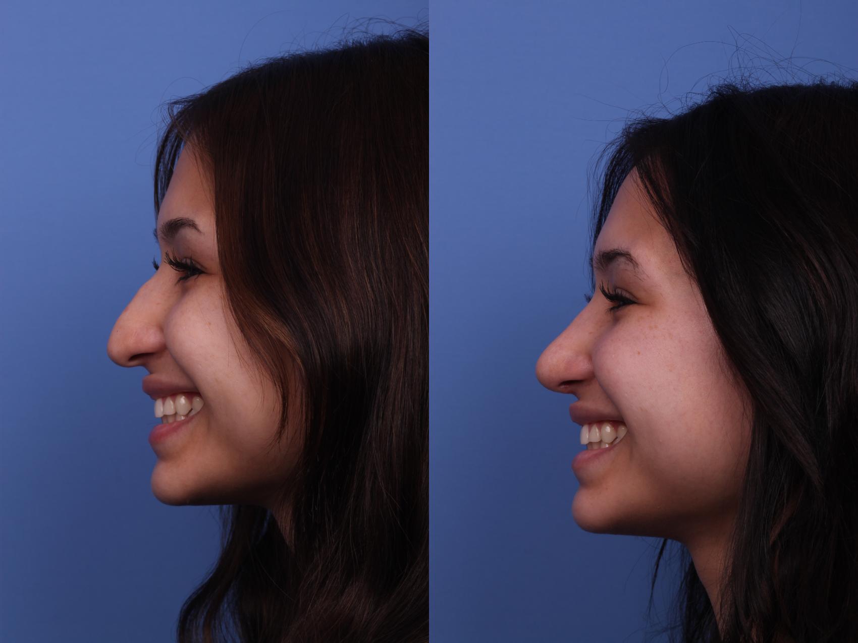 Before & After Rhinoplasty Case 301 View #3 View in Scottsdale, AZ