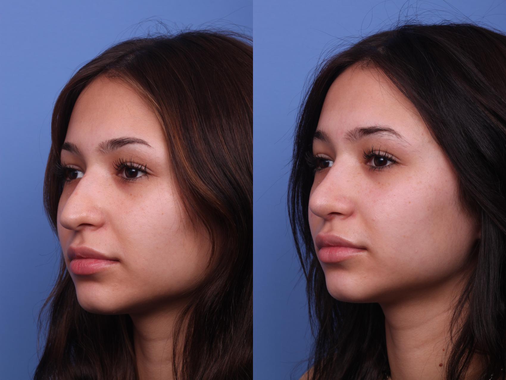 Before & After Rhinoplasty Case 301 View #4 View in Scottsdale, AZ