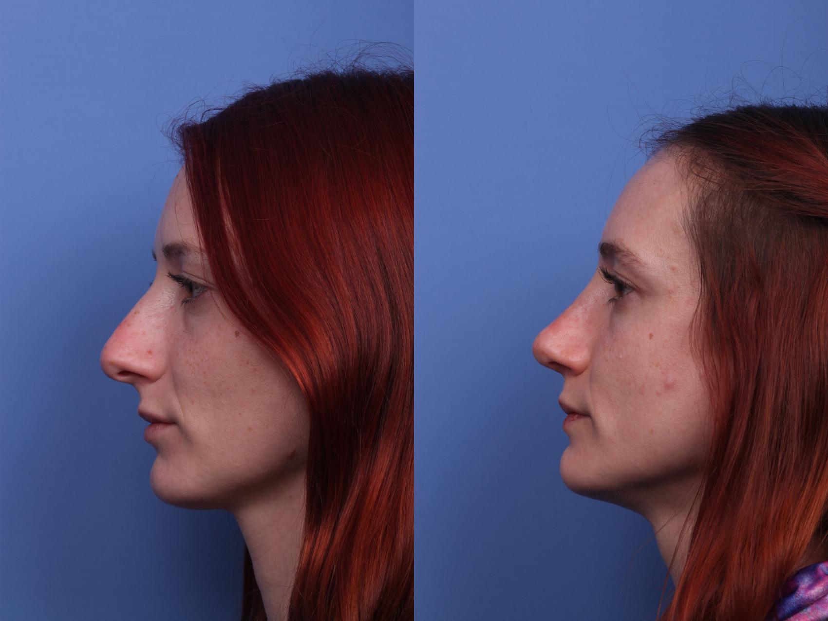 Before & After Rhinoplasty Case 304 View #2 View in Scottsdale, AZ