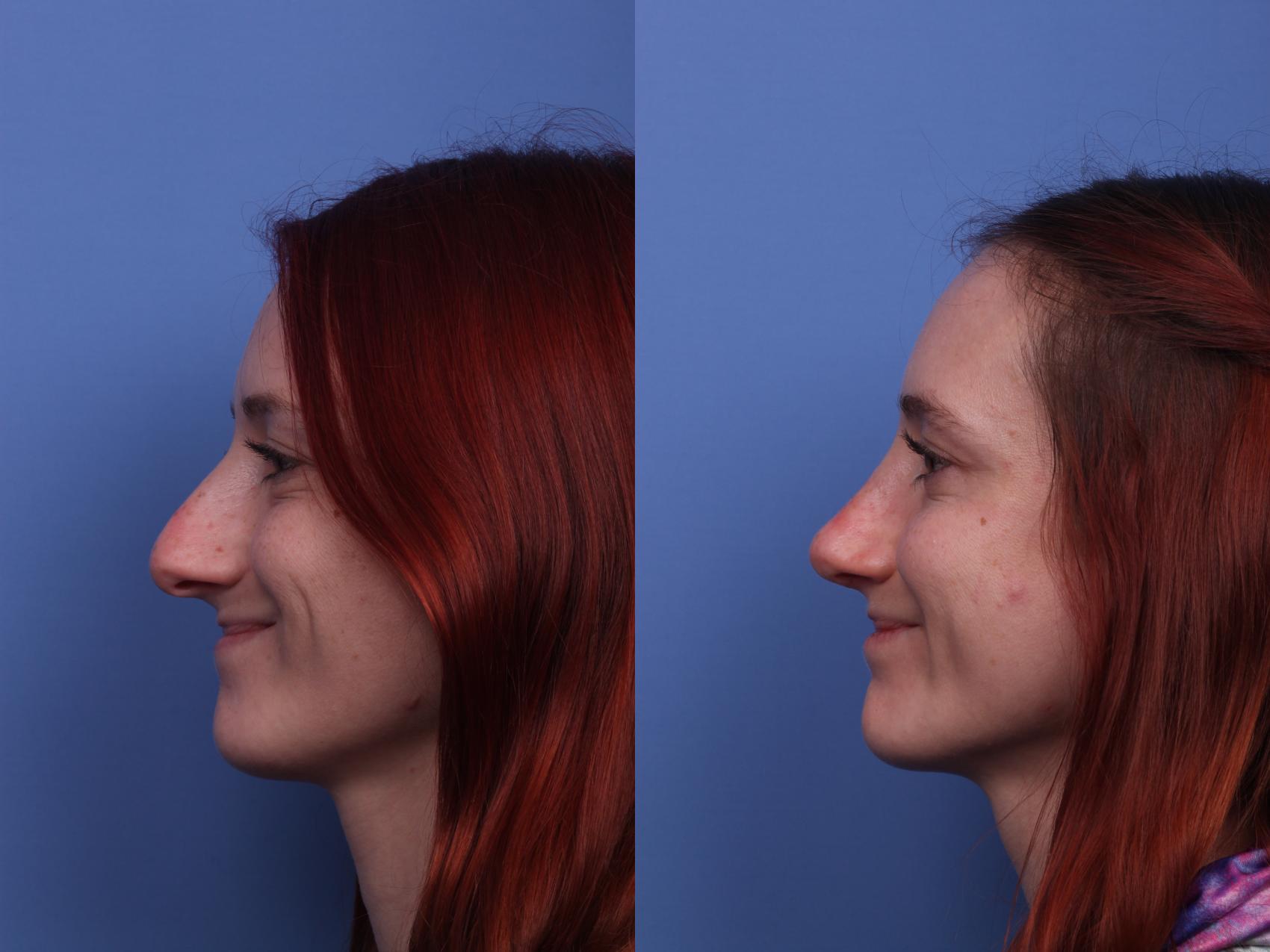 Before & After Rhinoplasty Case 304 View #3 View in Scottsdale, AZ