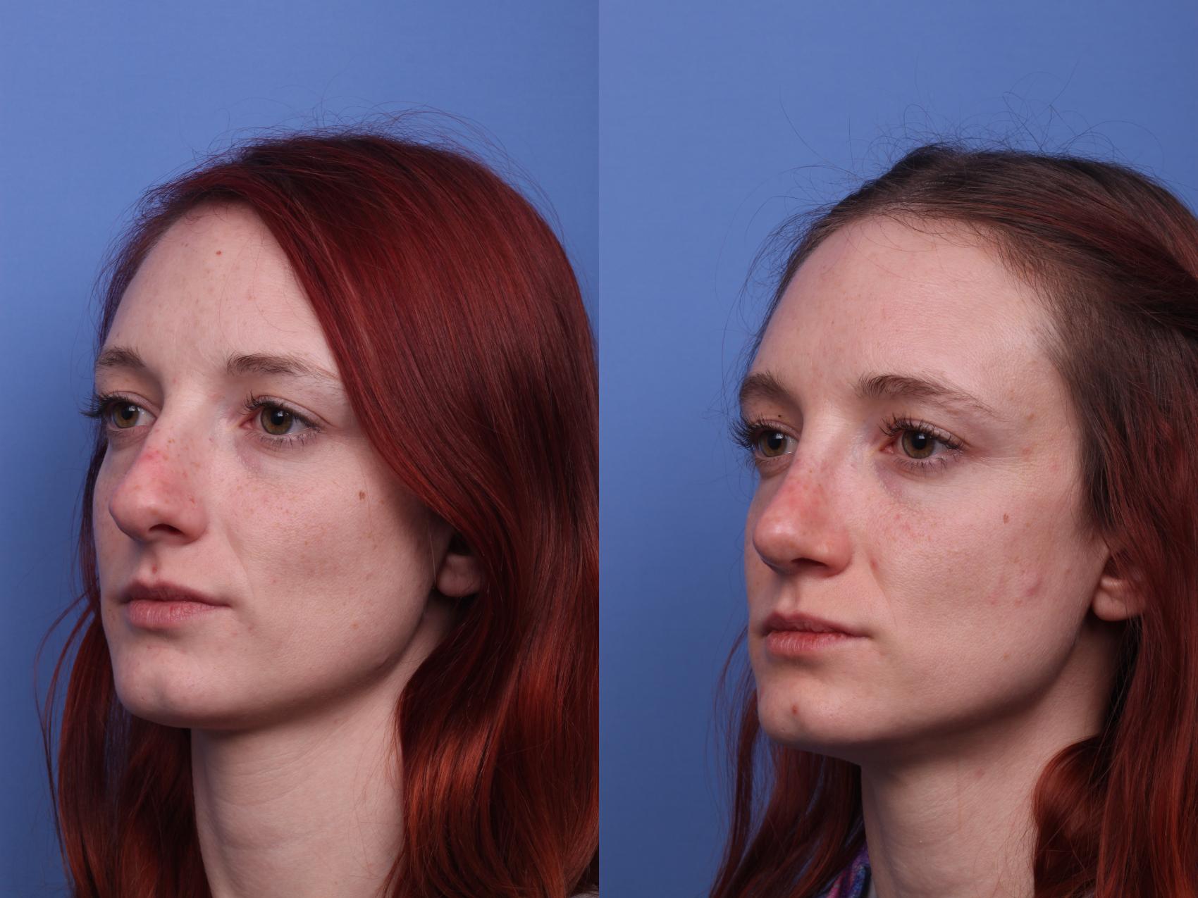 Before & After Rhinoplasty Case 304 View #4 View in Scottsdale, AZ