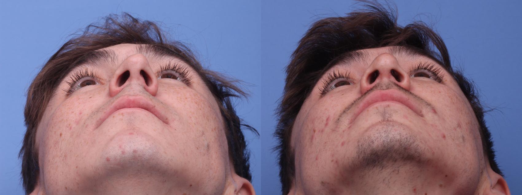 Before & After Rhinoplasty Case 305 View #2 View in Scottsdale, AZ