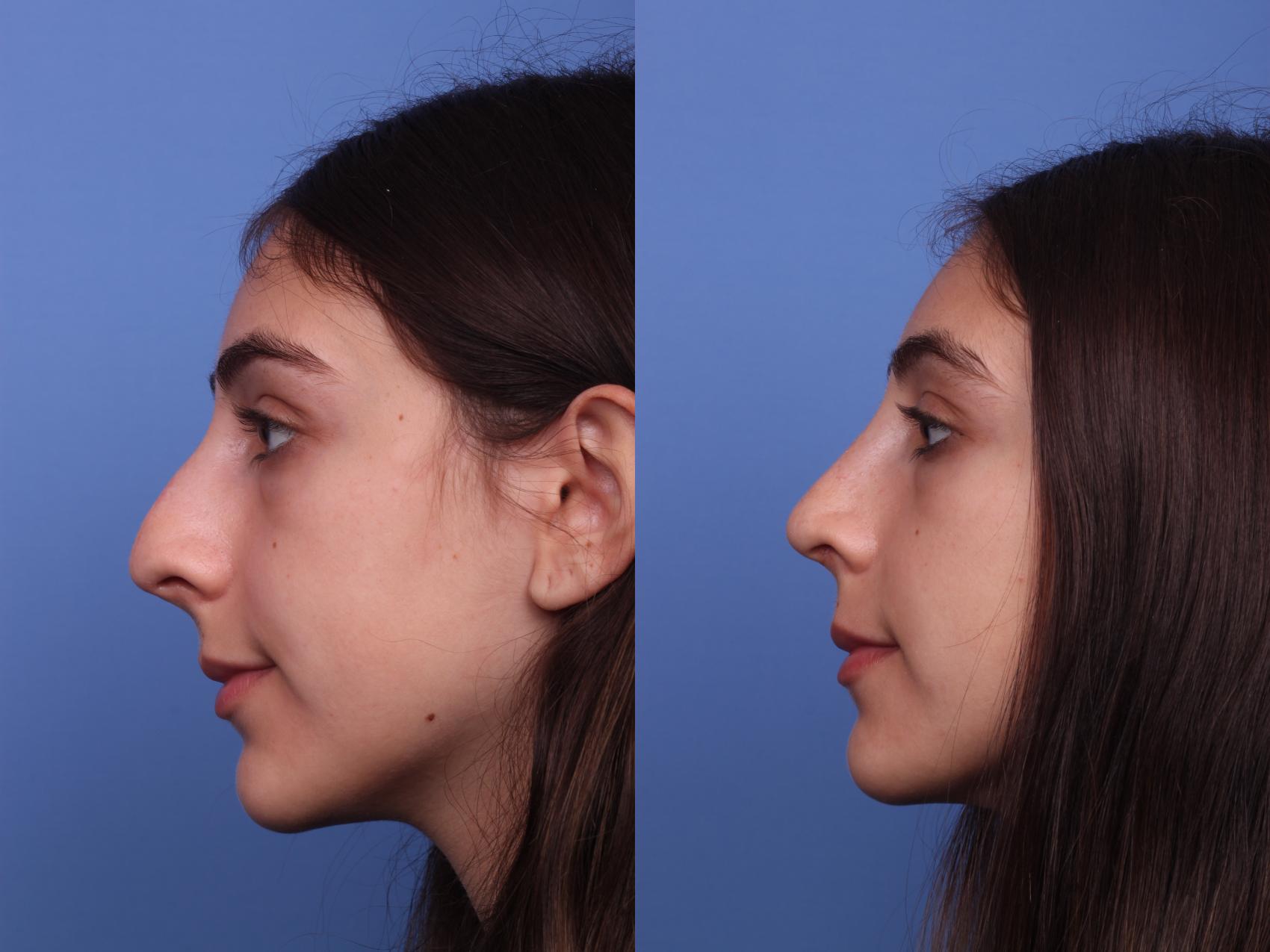 Before & After Rhinoplasty Case 306 View #2 View in Scottsdale, AZ