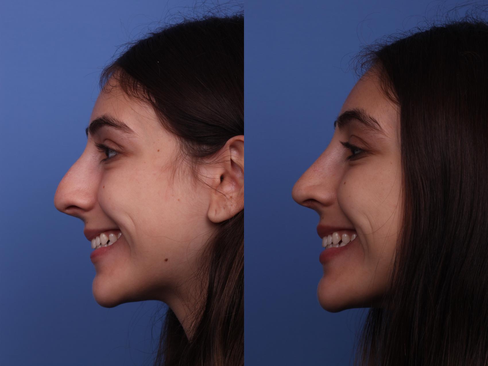 Before & After Rhinoplasty Case 306 View #3 View in Scottsdale, AZ