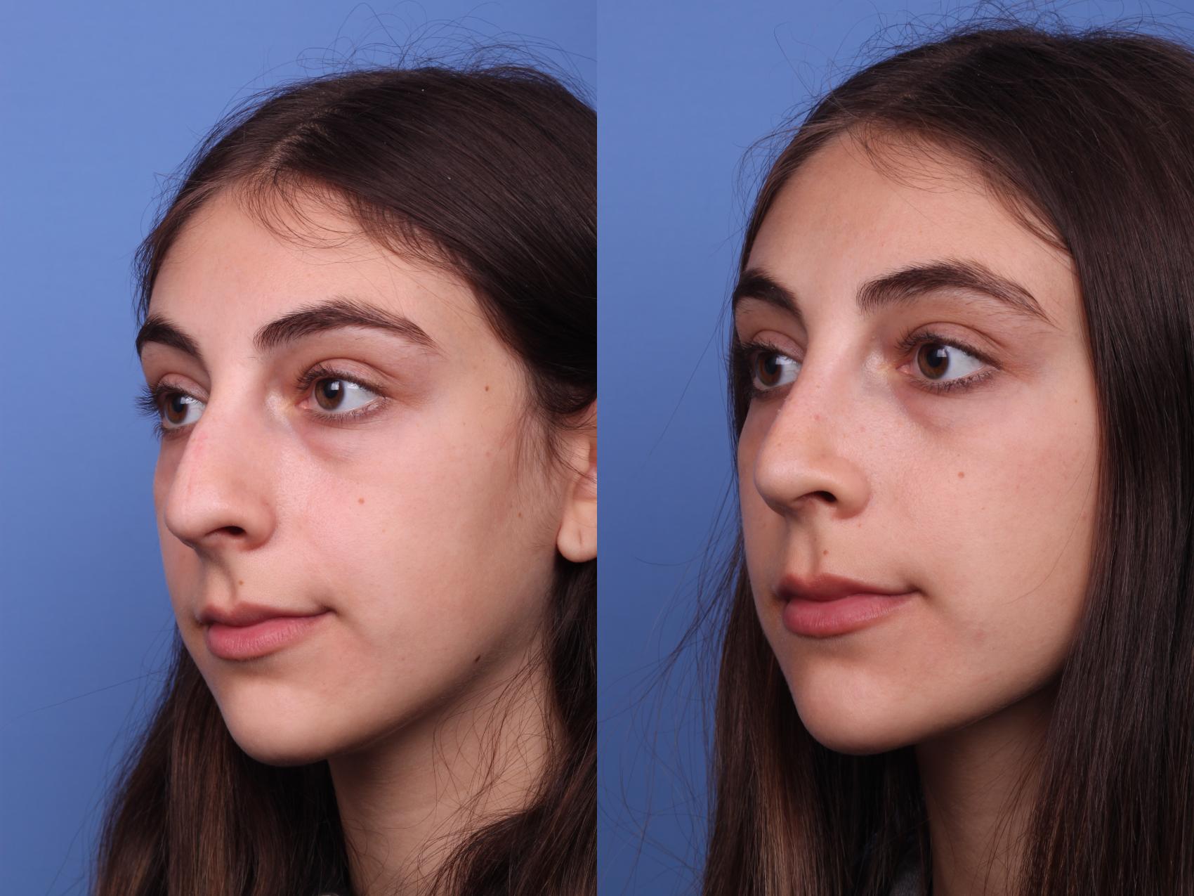 Before & After Rhinoplasty Case 306 View #4 View in Scottsdale, AZ