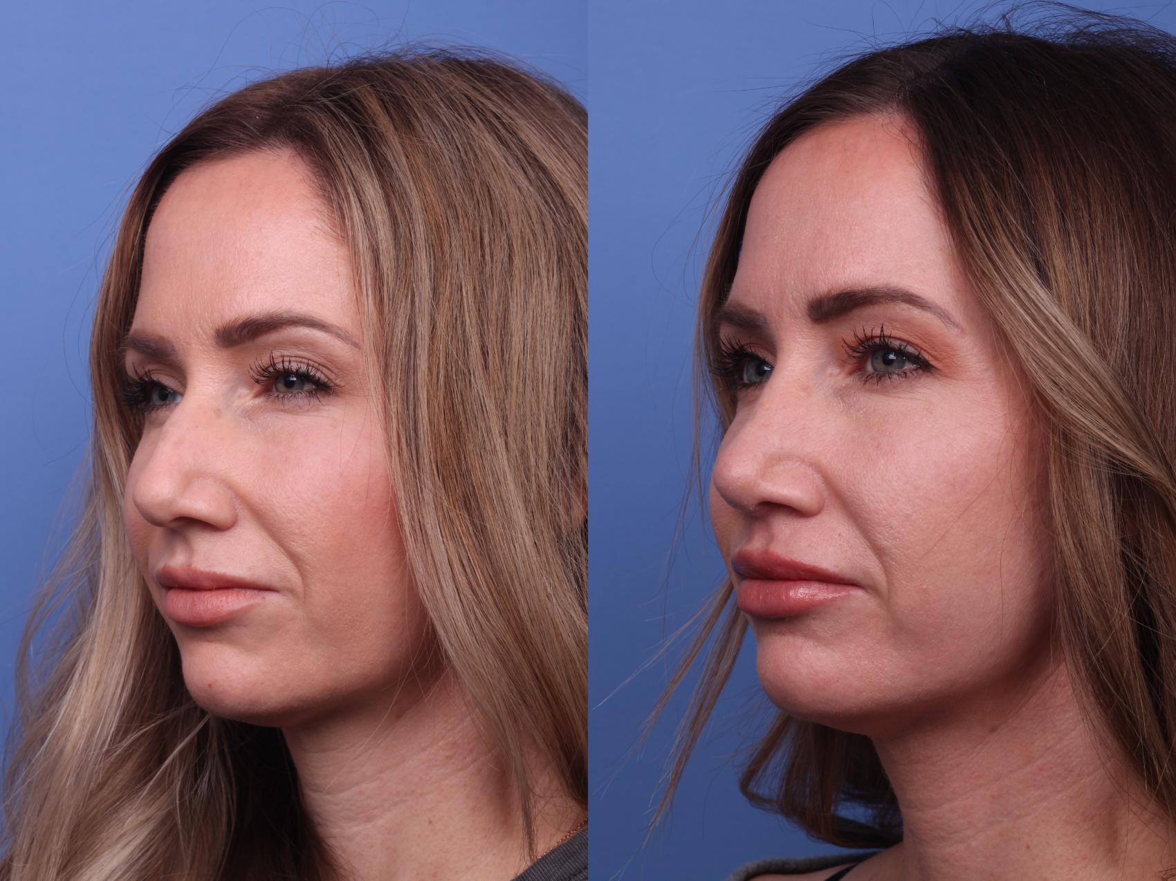 Before & After Rhinoplasty Case 307 View #2 View in Scottsdale, AZ