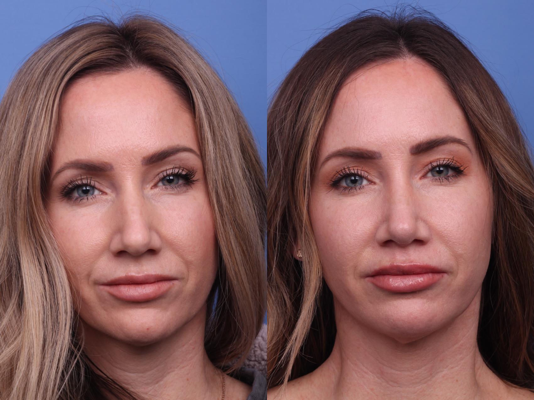 Before & After Rhinoplasty Case 307 View #3 View in Scottsdale, AZ