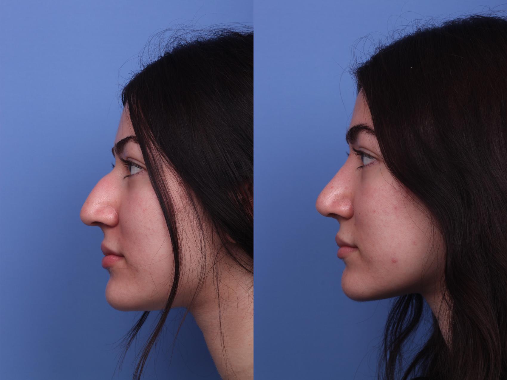 Before & After Rhinoplasty Case 309 View #2 View in Scottsdale, AZ