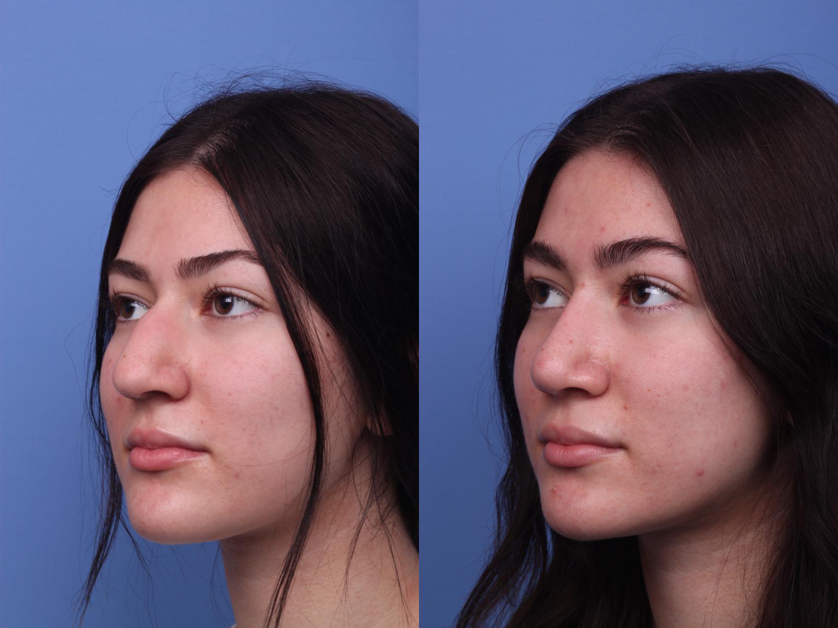 Before & After Rhinoplasty Case 309 View #3 View in Scottsdale, AZ