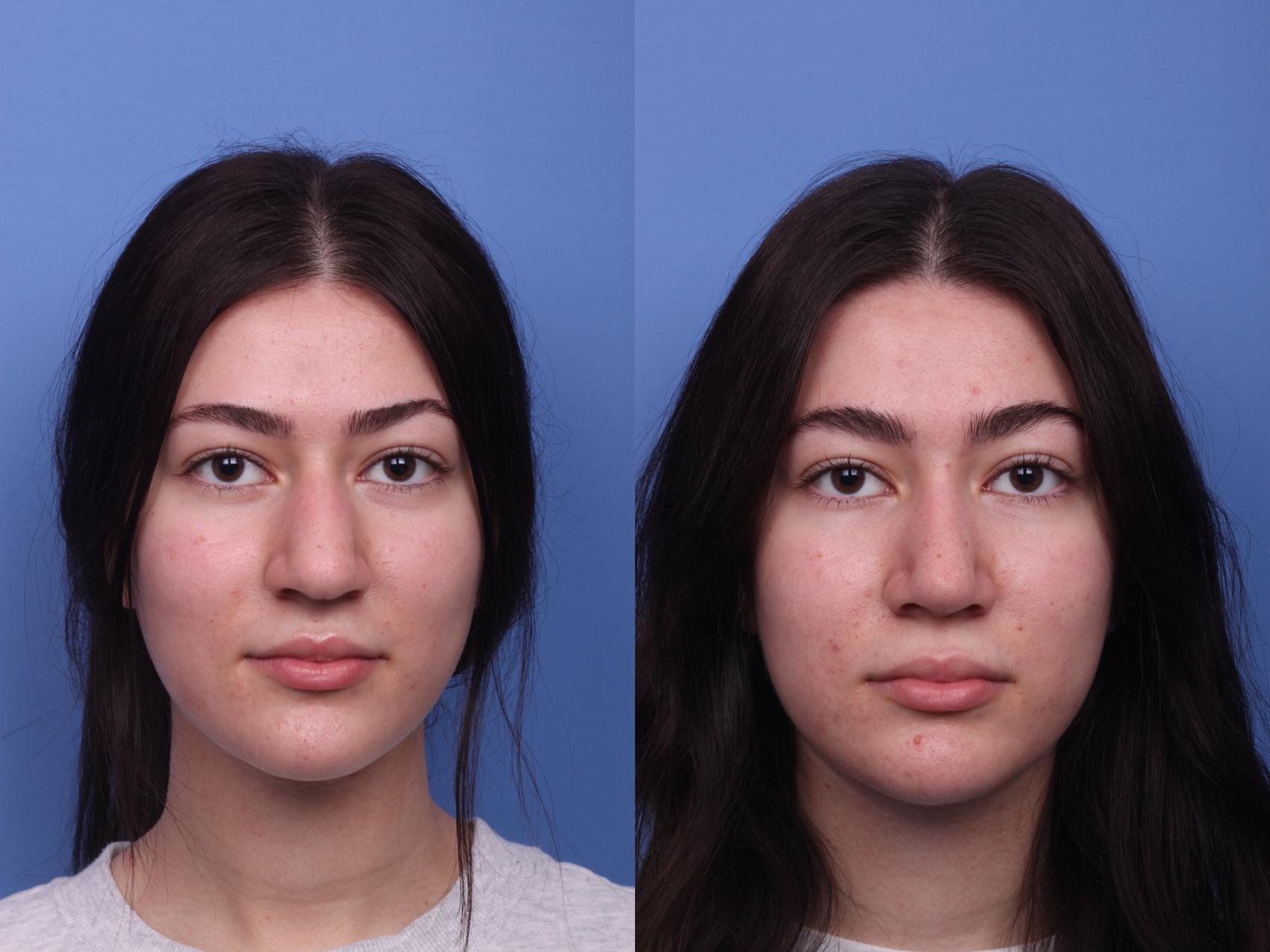 Before & After Rhinoplasty Case 309 View #4 View in Scottsdale, AZ