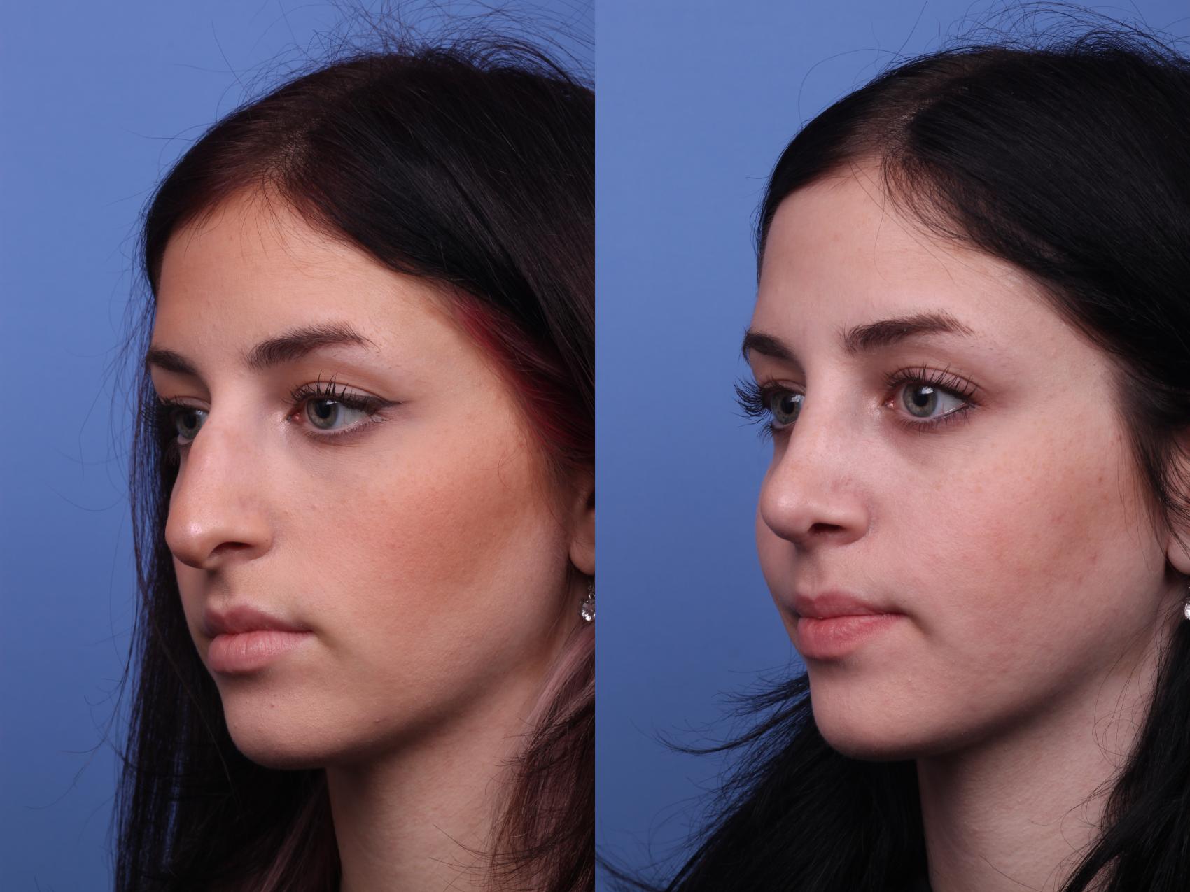 Before & After Rhinoplasty Case 311 View #2 View in Scottsdale, AZ