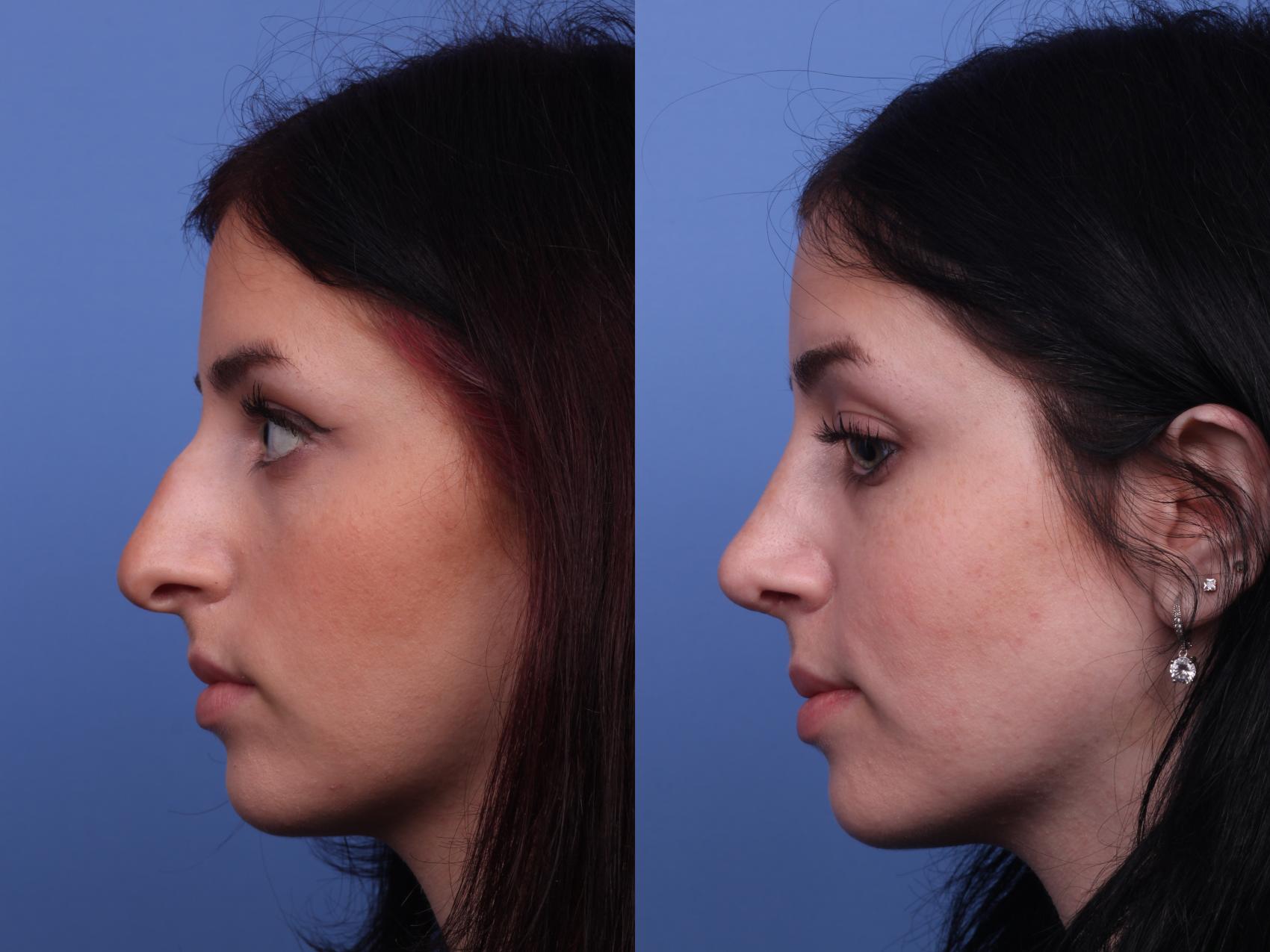 Rhinoplasty Before & After Photo | Scottsdale & Phoenix, AZ | Hobgood Facial Plastic Surgery: Todd Hobgood, MD