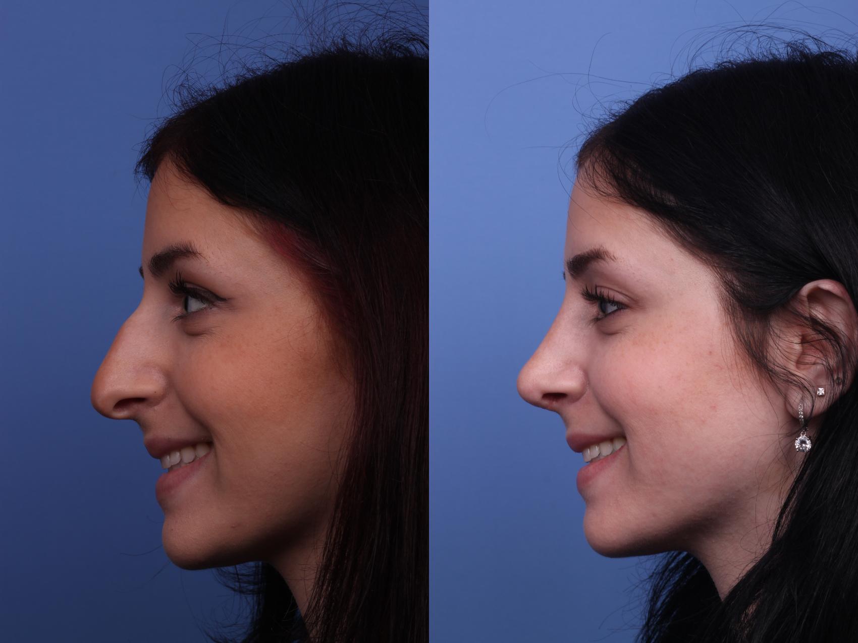 Before & After Rhinoplasty Case 311 View #4 View in Scottsdale, AZ