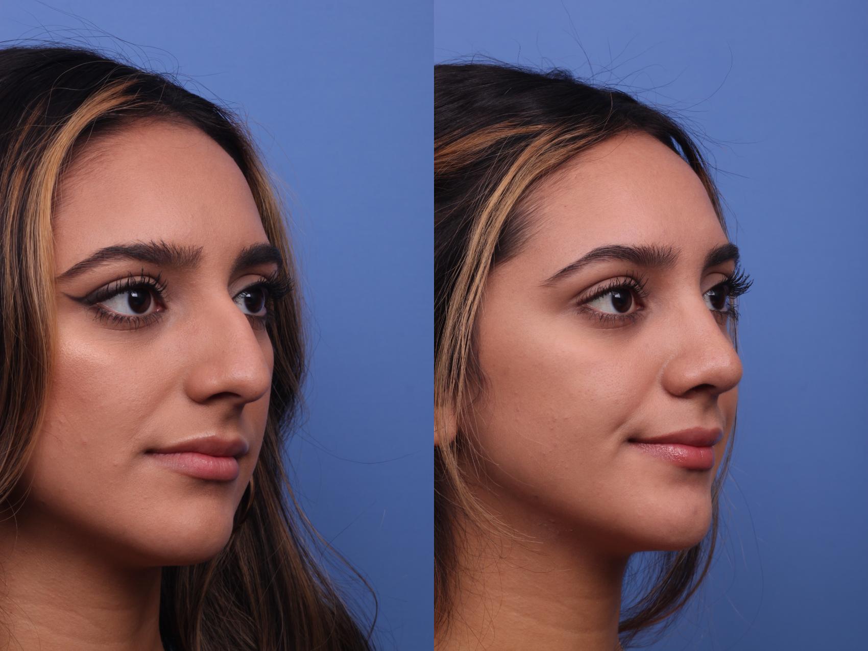 Before & After Rhinoplasty Case 313 View #2 View in Scottsdale, AZ