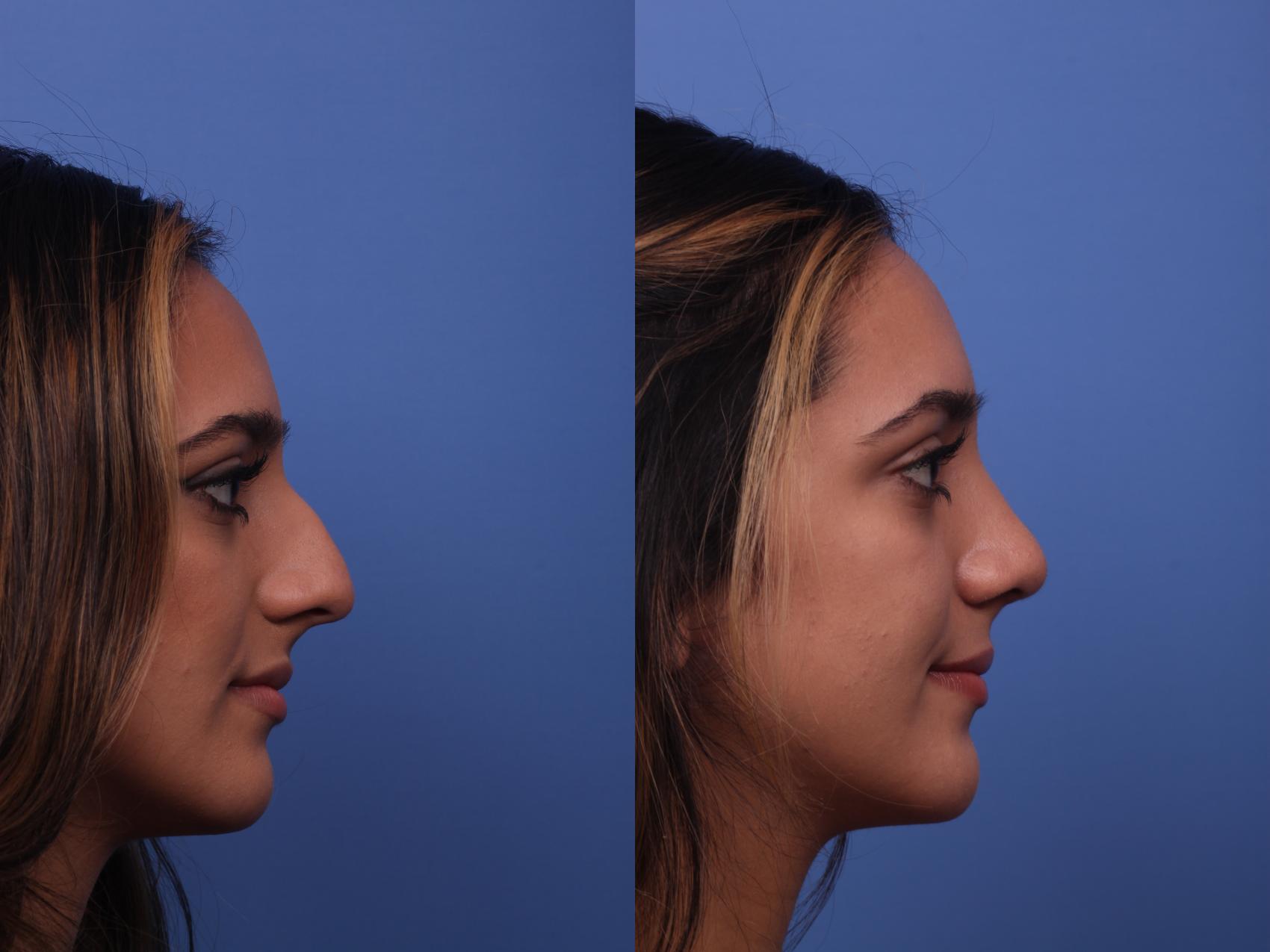 Before & After Rhinoplasty Case 313 View #3 View in Scottsdale, AZ