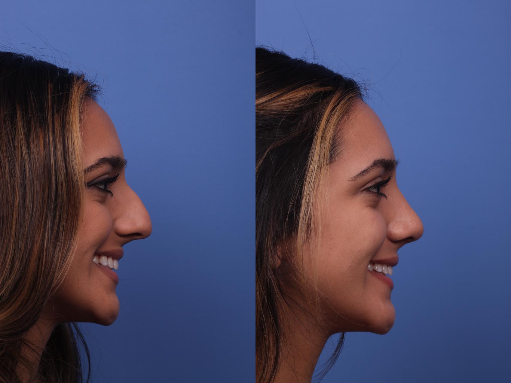 Before & After Rhinoplasty Case 313 View #4 View in Scottsdale, AZ
