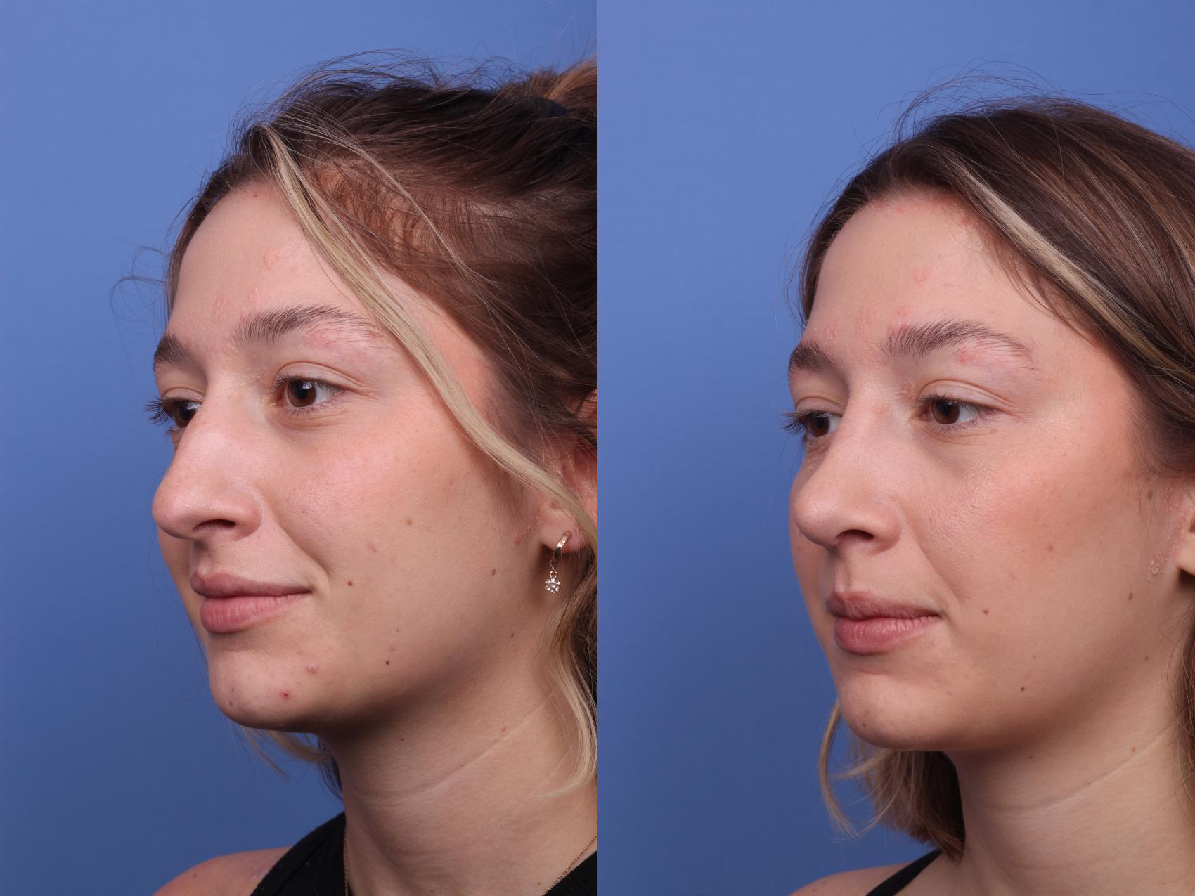 Before & After Rhinoplasty Case 315 View #2 View in Scottsdale, AZ