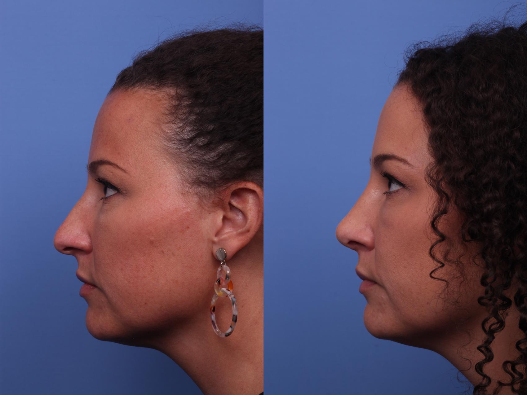 Before & After Rhinoplasty Case 316 View #1 View in Scottsdale, AZ