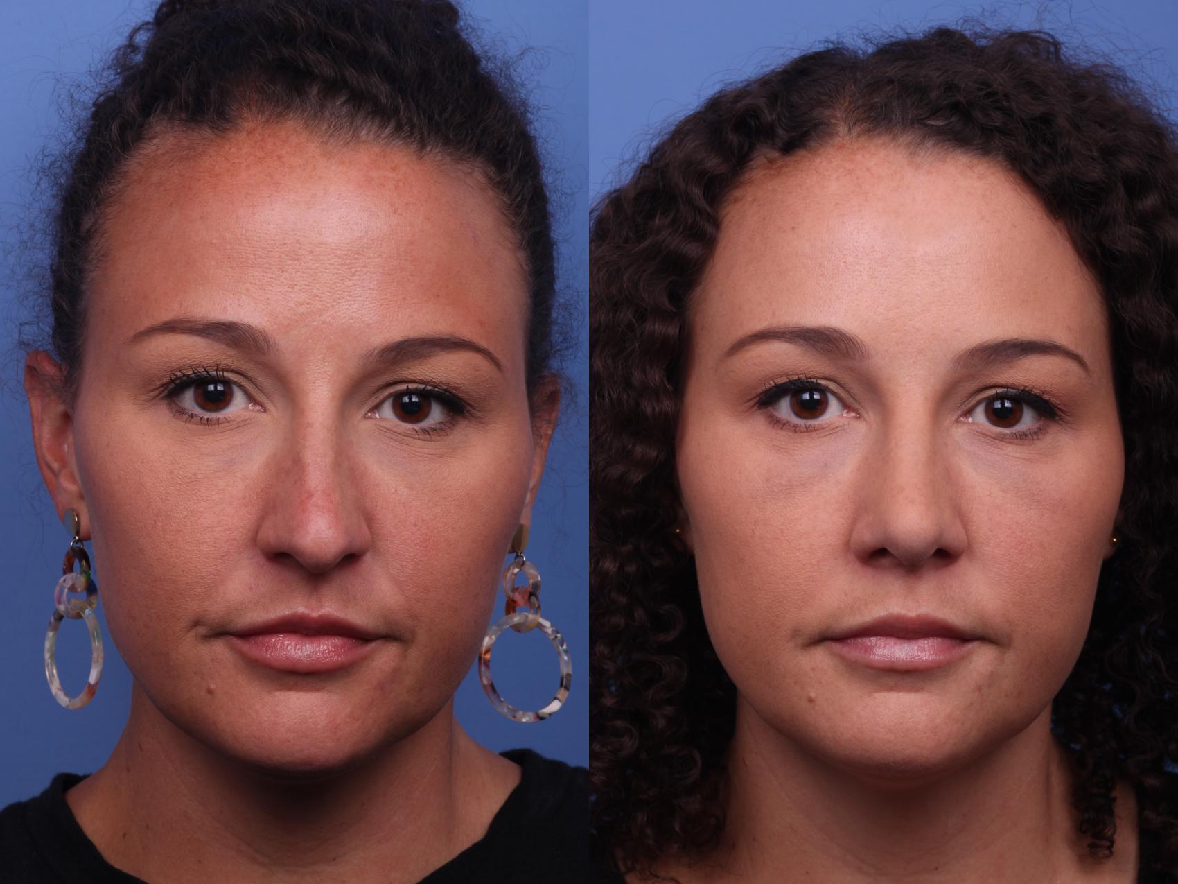Before & After Rhinoplasty Case 316 View #3 View in Scottsdale, AZ