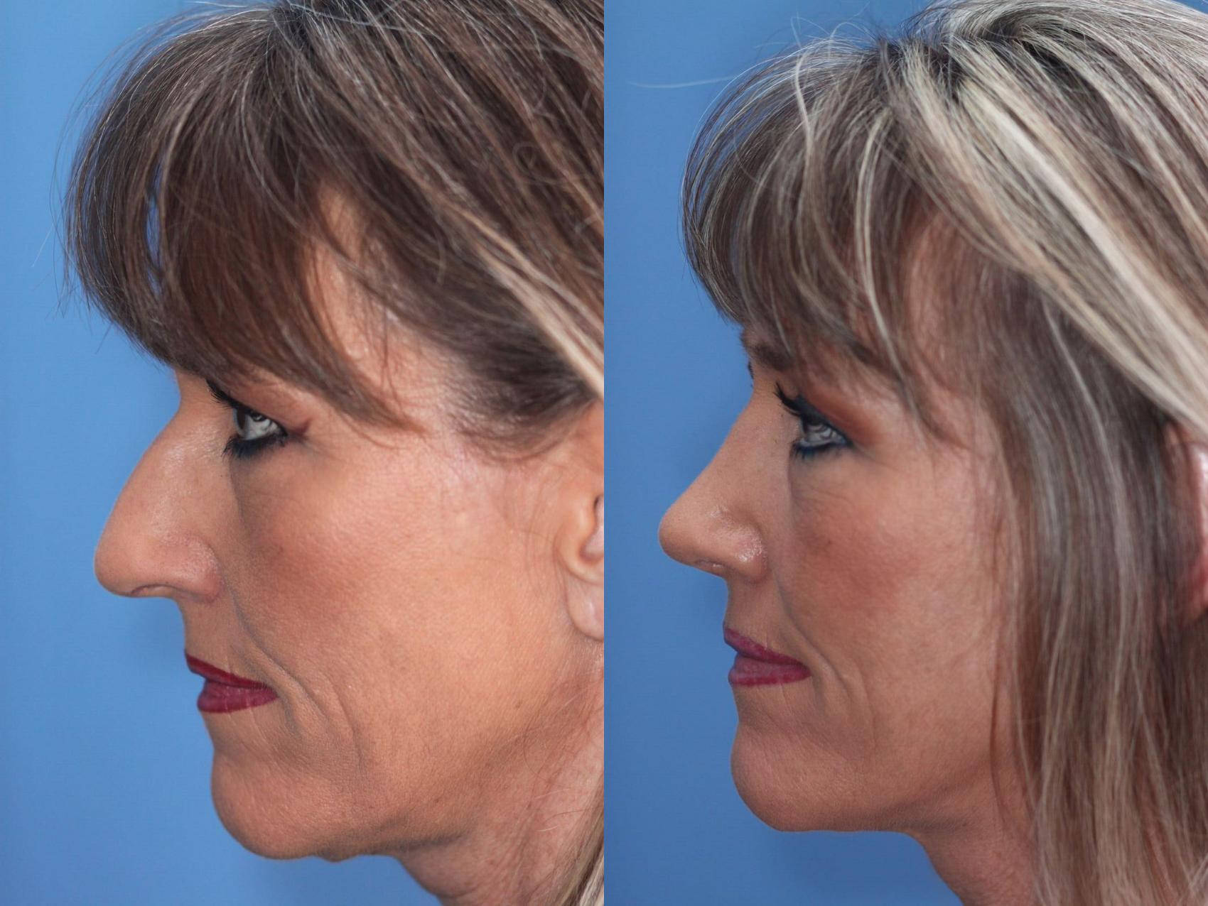 Before & After Rhinoplasty Case 32 View #2 View in Scottsdale, AZ
