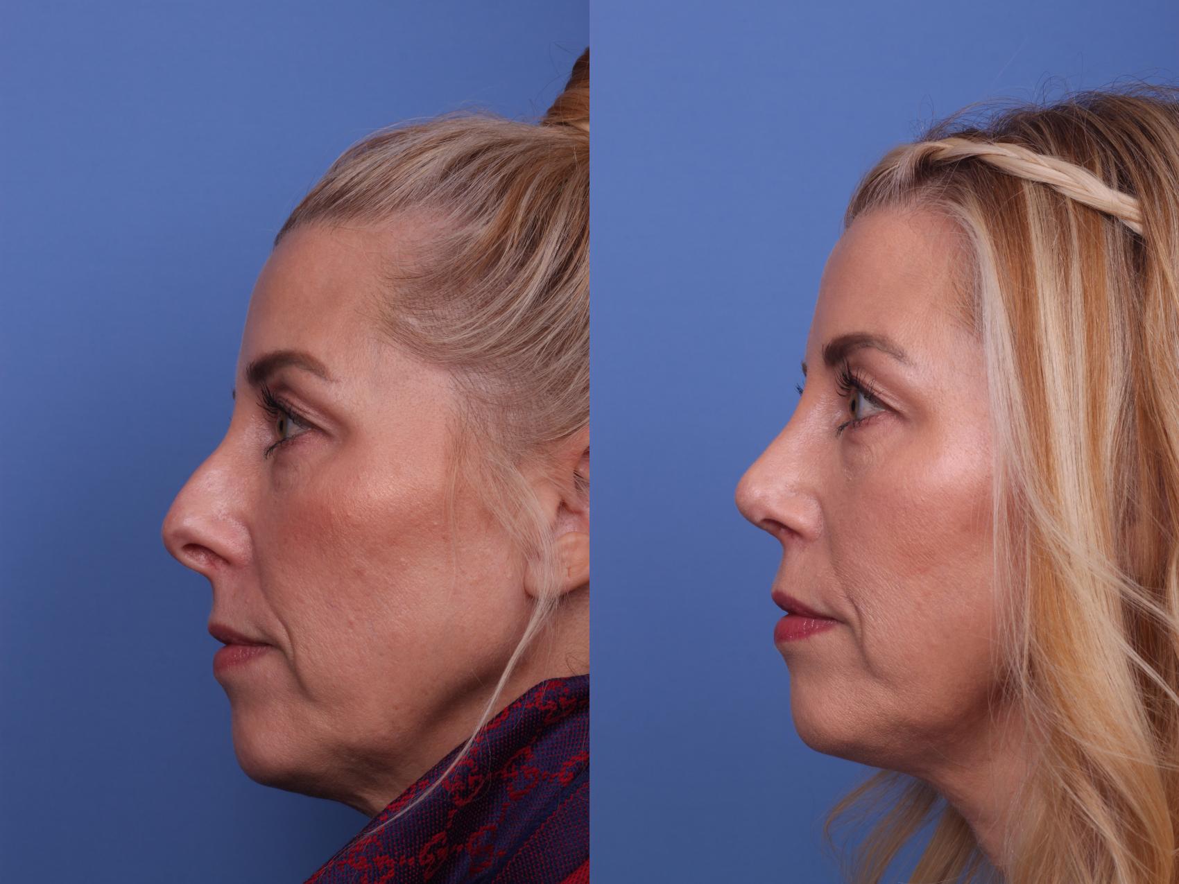 Before & After Rhinoplasty Case 321 View #2 View in Scottsdale, AZ