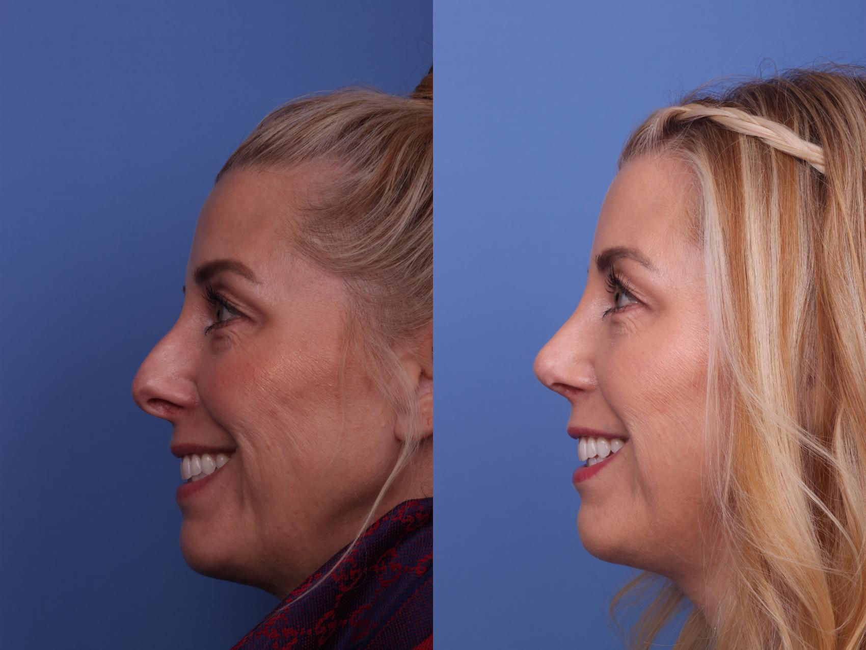Before & After Rhinoplasty Case 321 View #3 View in Scottsdale, AZ