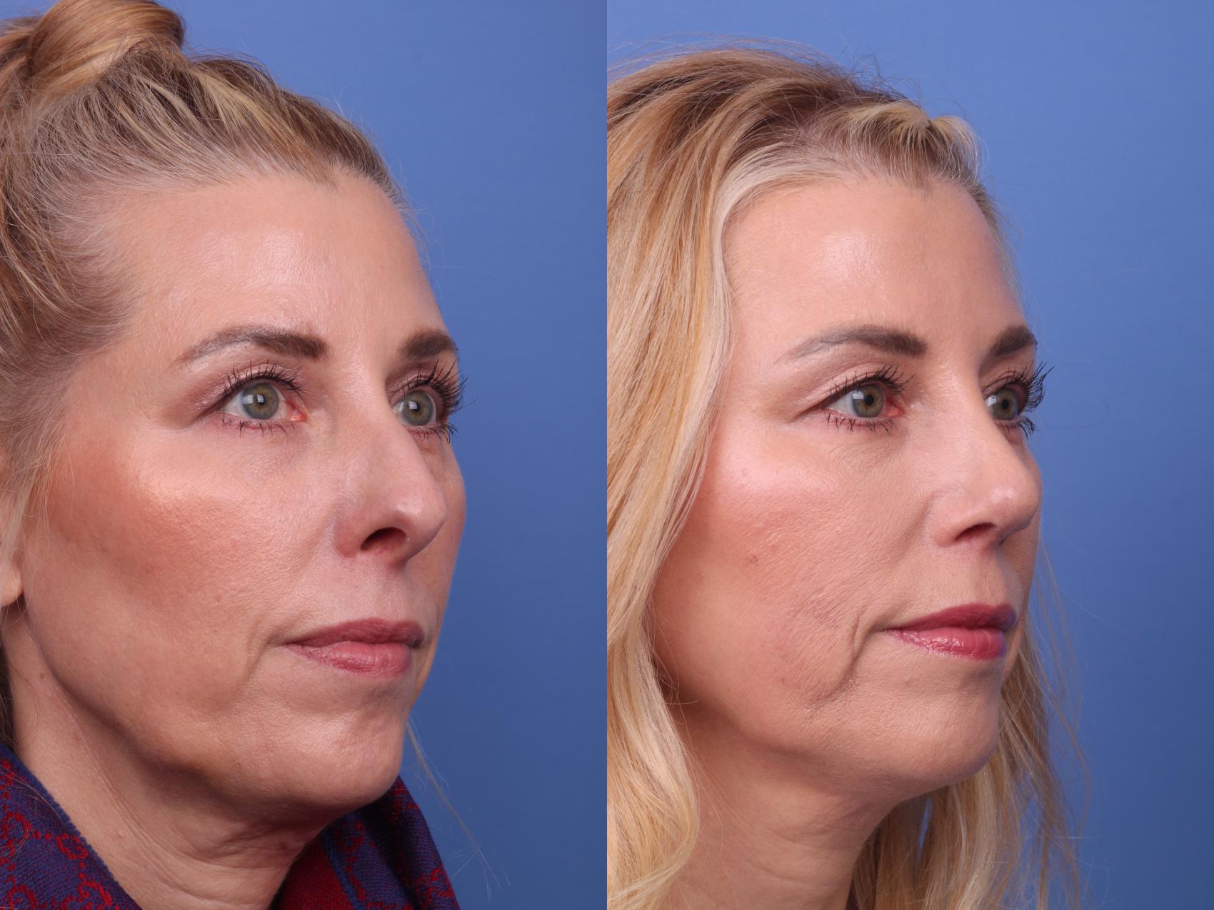 Before & After Rhinoplasty Case 321 View #4 View in Scottsdale, AZ